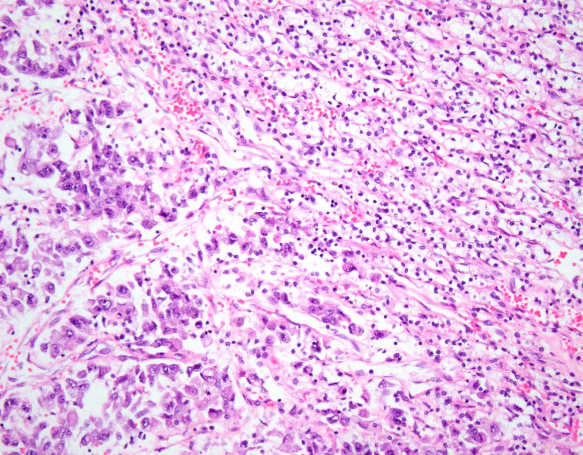 Abrupt transition from low to high nuclear grade in this Clear Cell Renal Cell Carcinoma #gupath #kidneycancer - highlighting the importance of sampling