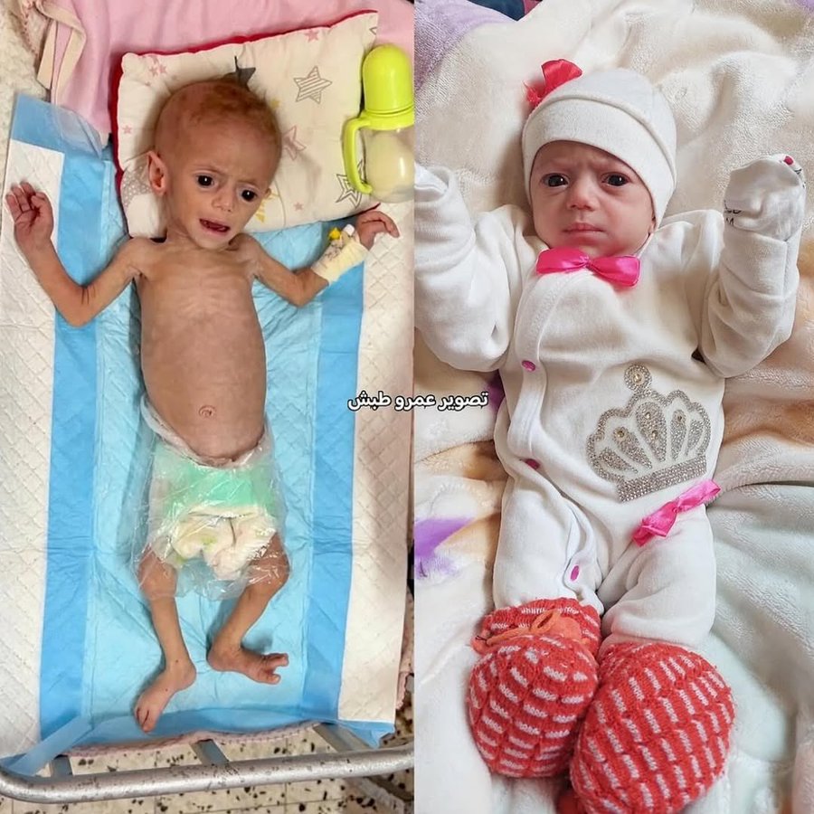 ruyaselcuk's tweet photo. 65,000 children in Gaza hospitalized with severe malnutrition.

Please do not remain silent on Gaza.💔

#StopIsrael #GazaGenocide #FreePalestine #Gaza #GazaHolocaust https://t.co/LYsk77vvv9