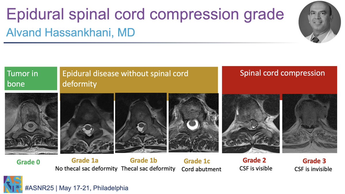 The American Society of Neuroradiology (@theasnr) on Twitter photo Dr. Hassankhani will presenting spine tumor board during this Tuesday session. Join the conversation at 3:20 pm in Grand Ballroom A/B.
#ASNR25 #Neurorad #Neuroradiology
<a href="/alvand26/">Alvand Hassankhani</a> Dr. Hassankhani will presenting spine tumor board during this Tuesday session. Join the conversation at 3:20 pm in Grand Ballroom A/B.
#ASNR25 #Neurorad #Neuroradiology
<a href="/alvand26/">Alvand Hassankhani</a>