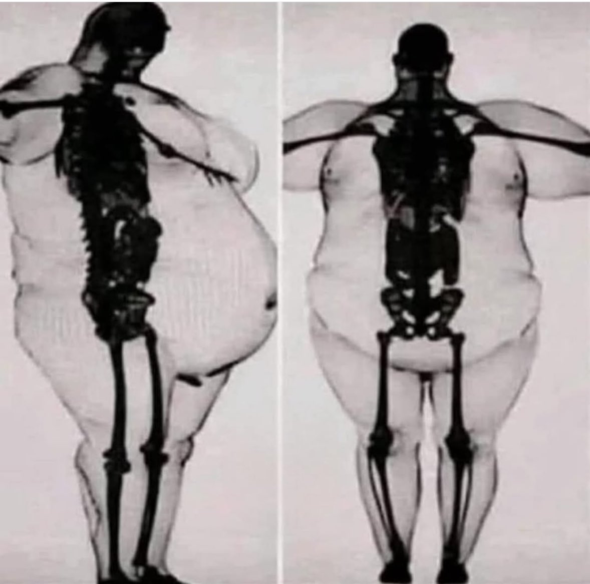 Digan lo que digan… la obesidad no es buena, ni saludable

Radiografía real que muestra la relación entre el esqueleto y la nasa corporal. Los huesos son como los tuyos pero deben soportar mucho más peso

Las rodillas, la columna, caderas, corazón, hígado, páncreas… ⛔️