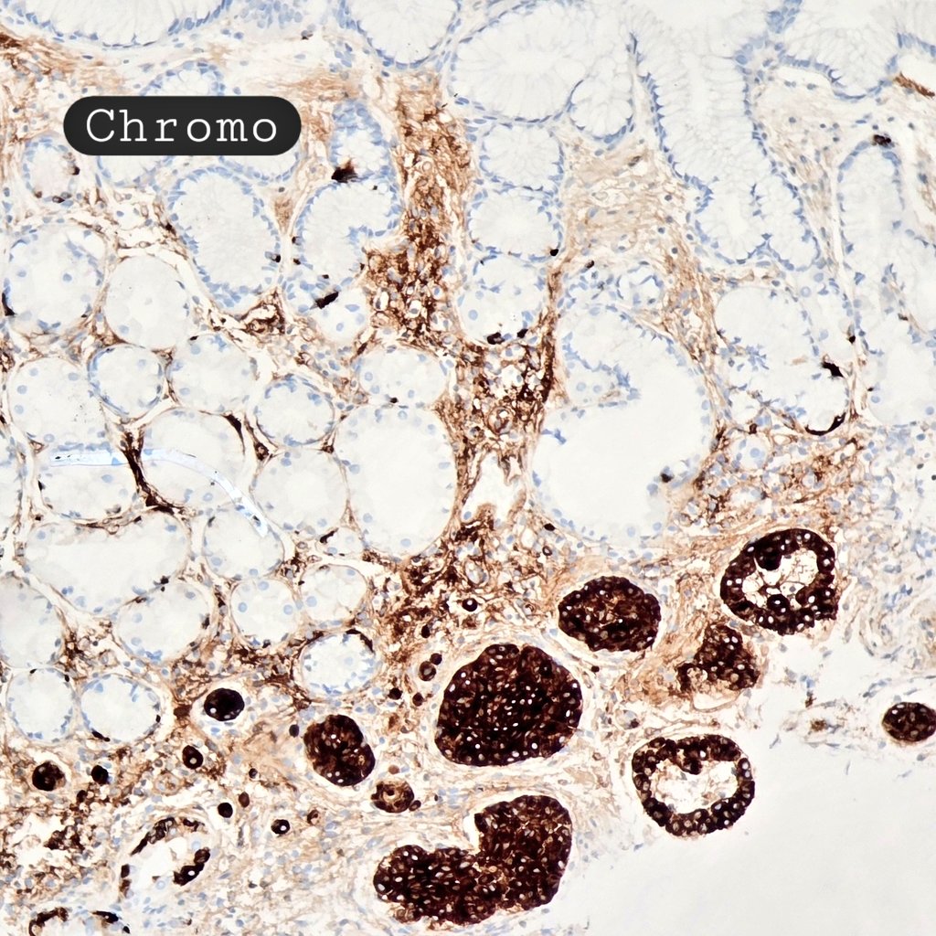 Type I stomach NET

-More common in the gastric body -often multifocal
-usually &lt;2cm
🔬Arranged in nests,cords or trabeculae
🔬Bland,round cells with salt &amp; pepper chromatin &amp; amphophilic cytoplasm
🔬background oxyntic mucosa is atrophic with metaplasia with ECL cell hyperplasia