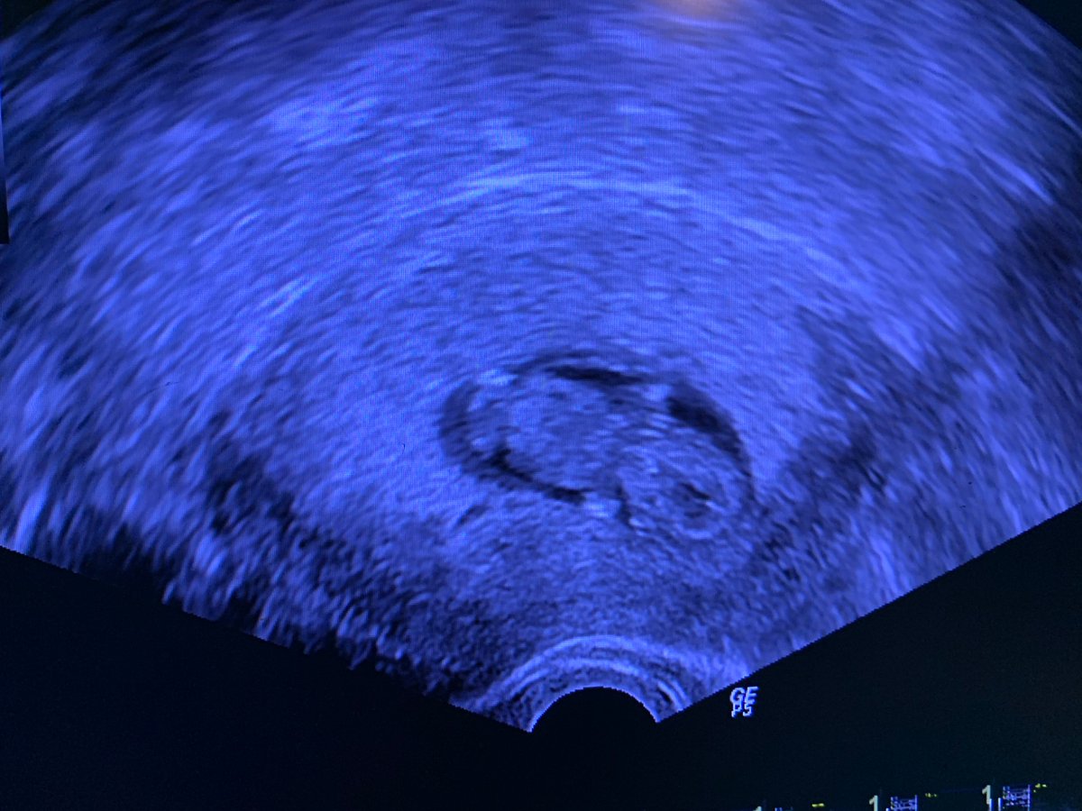 yarnreader_Sam's tweet photo. 8 years in the making.
After waiting 8 years, our little wonder will make his grand entrance at the tail end of the year. Stoic Ervin, we cannot wait until you are finally home with us. https://t.co/lnNMxrmdWG