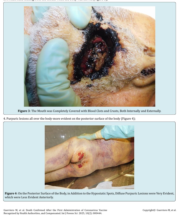 🚨📢URGENT: New Report Now Published - 20 May 2025 - Death of a 72-year-old man in 2021 was officially acknowledged by Italian health authorities to be caused by the COVID-19 Vaccine, and the family was compensated in 2024 with approximately €100,000. Warning Graphic Content.