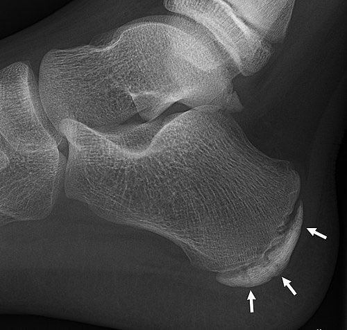 pt_wasan's tweet photo. بنتكلم عن حالة Sever’s disease  ( داءُ سيفِر )🦶🏻
والمعروفة بإسم (التهاب النتوء العقبي)

تُشبه حالة Osgood -Schlatter disease 

تصيب اليافعين الرياضيين والنشطين من ٩ إلى ١٣ سنة 🏃🏽
#علاج_طبيعي https://t.co/Ro7Sq11Sbq