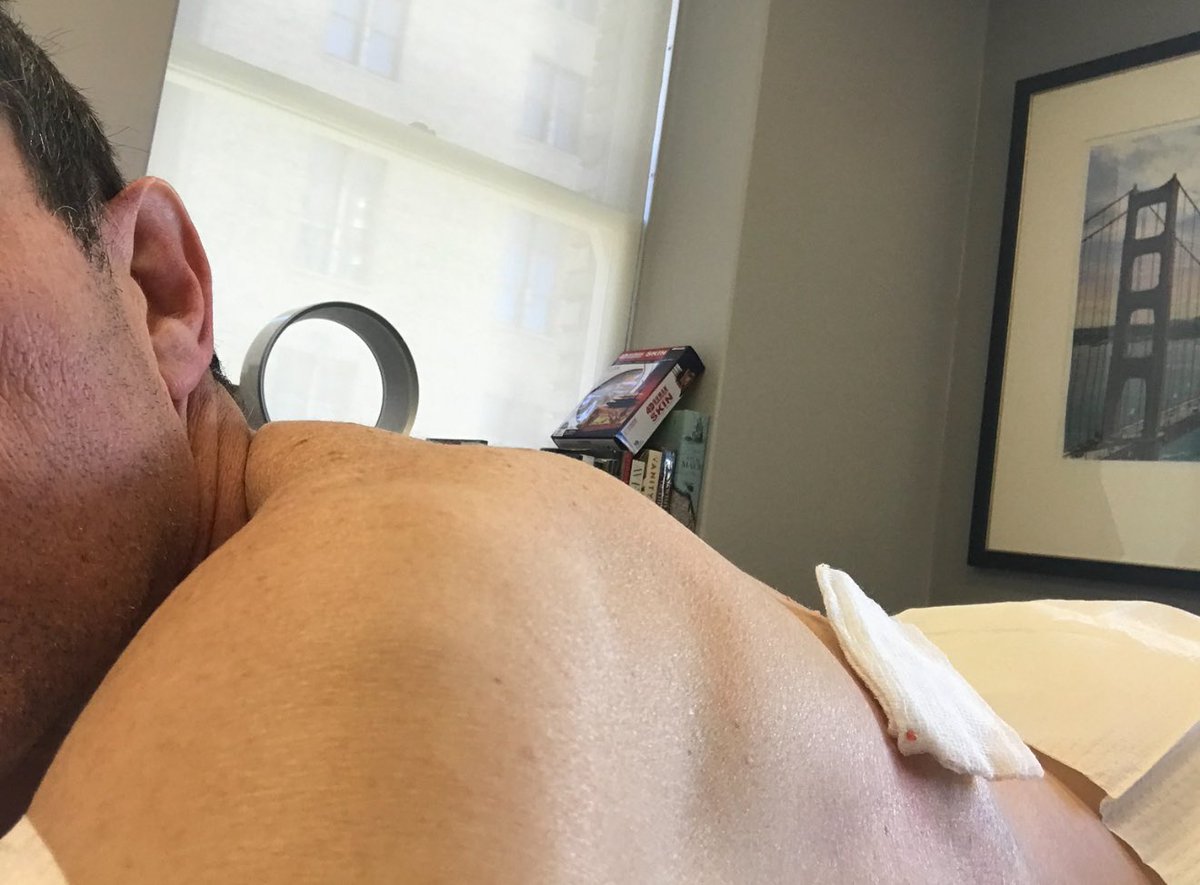 Nicholas Colyvas MD (@drnickcolyvas) on Twitter photo Any <a href="/dermatology/">dermRounds</a> colleagues seen this before ?
I had one of these removed last year. Surgeon was unaware that these occurred
thesportsrush.com/f1-news-esteba… Any <a href="/dermatology/">dermRounds</a> colleagues seen this before ?
I had one of these removed last year. Surgeon was unaware that these occurred
thesportsrush.com/f1-news-esteba…