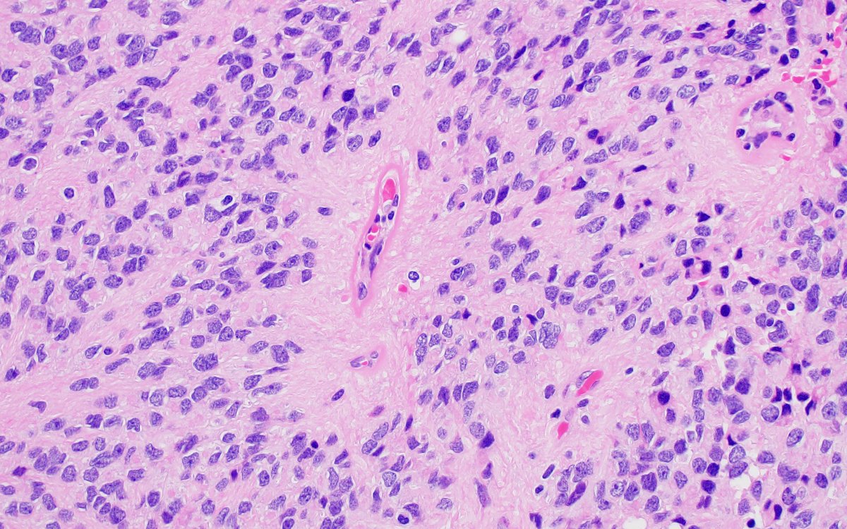 H&amp;E from a cervical intramedullary (I.e., within the spinal cord) tumor. Most likely diagnosis? #neuropath 🧠🔬