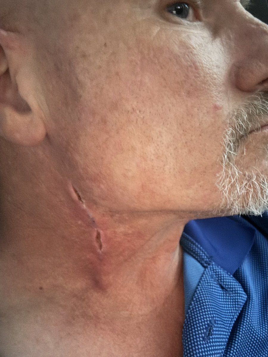 master_balloons's tweet photo. About a month out of surgery. Still have some healing to do. I had heart surgery and carotid artery surgery. https://t.co/WIpUsXe1QH