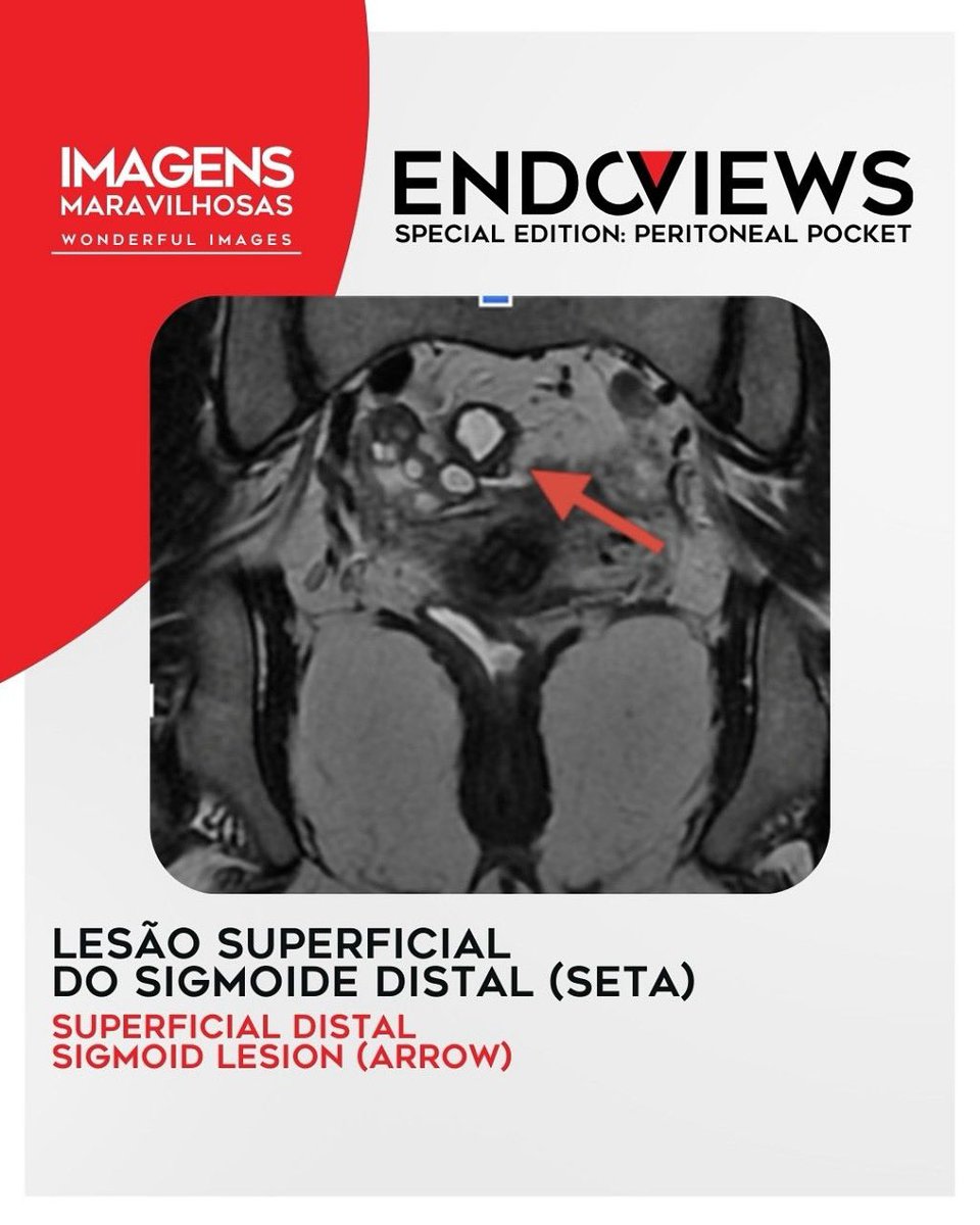endoviews's tweet image. Lesão superficial no sigmoide distal: achado sutil, mas importante no diagnóstico da endometriose intestinal.
Superficial distal sigmoid lesion: a subtle but relevant finding in intestinal endometriosis.