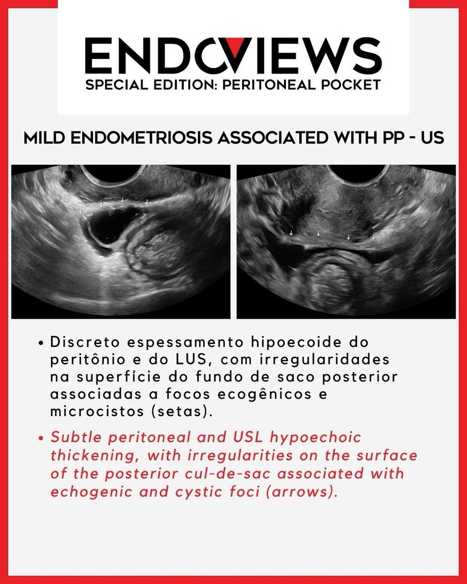 endoviews's tweet image. Lesão superficial no sigmoide distal — achado sutil, mas importante na endometriose intestinal.
Superficial distal sigmoid lesion — subtle but relevant in intestinal endometriosis.
