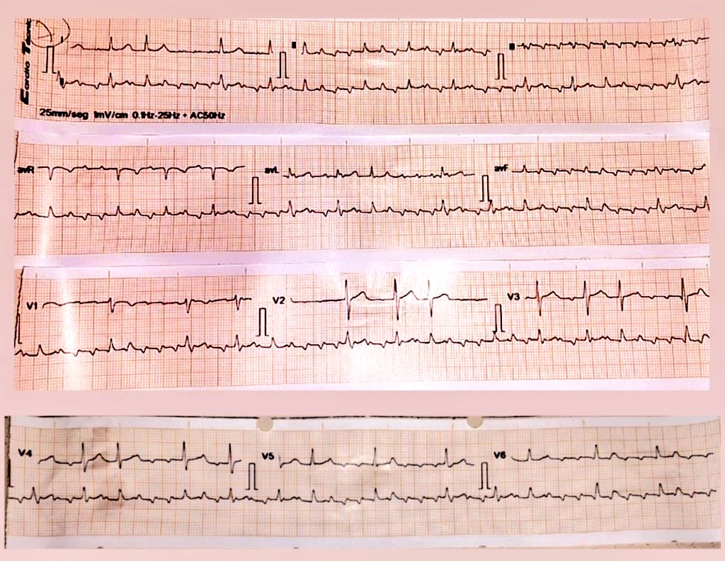 Nelson Polo Taborda (@nelsonpol) on Twitter photo 👧🏼 60 y/o. History of AVNRT ablation 4 years ago. <a href="/AThomazAndrade/">Antonio Thomaz de Andrade, MD 🇧🇷</a> <a href="/ErnestoMD2615/">Ernesto Barrantes</a> <a href="/DrRazi4/">Dr Razi</a> <a href="/MosqueaRubelin/">Dr. Rubelin mosquea</a> <a href="/ecgandrhythmRoe/">Dr. Andreas Roeschl</a> <a href="/ECGEPSCADEVICE/">色々自粛中(ガラス細工の様な繊細なハートを持つ貴公子🤴)サブ垢です🙇♂️</a> <a href="/gabims85/">Gabi Martin</a> <a href="/DrPireMariano/">Mariano Pire</a> <a href="/TomasDatino/">@TomasDatino</a> 👧🏼 60 y/o. History of AVNRT ablation 4 years ago. <a href="/AThomazAndrade/">Antonio Thomaz de Andrade, MD 🇧🇷</a> <a href="/ErnestoMD2615/">Ernesto Barrantes</a> <a href="/DrRazi4/">Dr Razi</a> <a href="/MosqueaRubelin/">Dr. Rubelin mosquea</a> <a href="/ecgandrhythmRoe/">Dr. Andreas Roeschl</a> <a href="/ECGEPSCADEVICE/">色々自粛中(ガラス細工の様な繊細なハートを持つ貴公子🤴)サブ垢です🙇♂️</a> <a href="/gabims85/">Gabi Martin</a> <a href="/DrPireMariano/">Mariano Pire</a> <a href="/TomasDatino/">@TomasDatino</a>