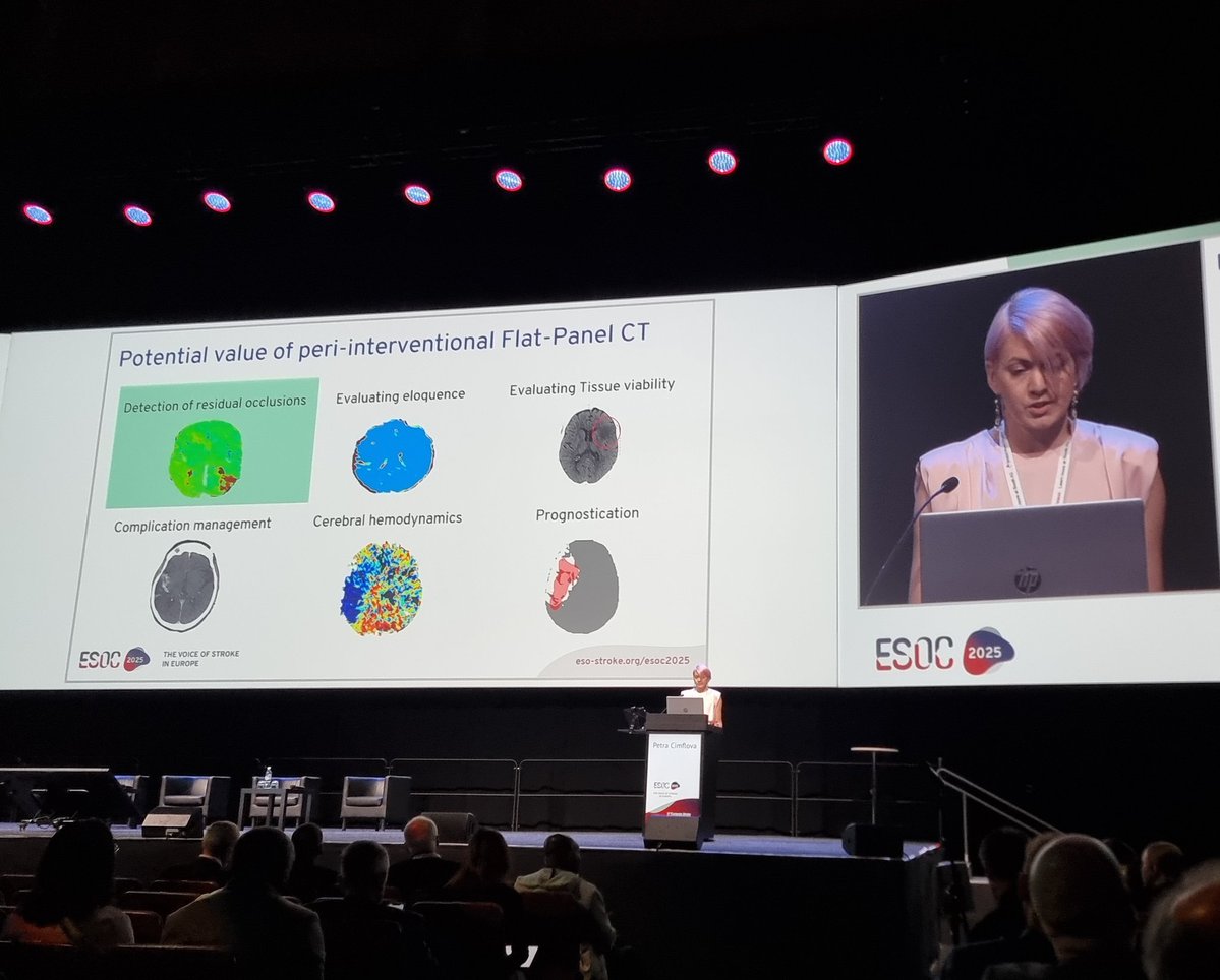 Stroke Research Center Bern (@strokebern) on Twitter photo Petra Cimflova from <a href="/StrokeBern/">Stroke Research Center Bern</a> at #ESOC2025 on the value of flat panel CT for #STROKE #IMAGING.
Huge potential to detect persistent distal occlusions and assessing eloquence and tissue viability.
<a href="/CheesemakerMD/">Johannes Kaesmacher</a> <a href="/adnan_mujanovic/">Adnan Mujanović</a>
<a href="/ShaokaiZheng/">Shaokai Zheng</a>
<a href="/ESOstroke/">European Stroke Org</a> Petra Cimflova from <a href="/StrokeBern/">Stroke Research Center Bern</a> at #ESOC2025 on the value of flat panel CT for #STROKE #IMAGING.
Huge potential to detect persistent distal occlusions and assessing eloquence and tissue viability.
<a href="/CheesemakerMD/">Johannes Kaesmacher</a> <a href="/adnan_mujanovic/">Adnan Mujanović</a>
<a href="/ShaokaiZheng/">Shaokai Zheng</a>
<a href="/ESOstroke/">European Stroke Org</a>
