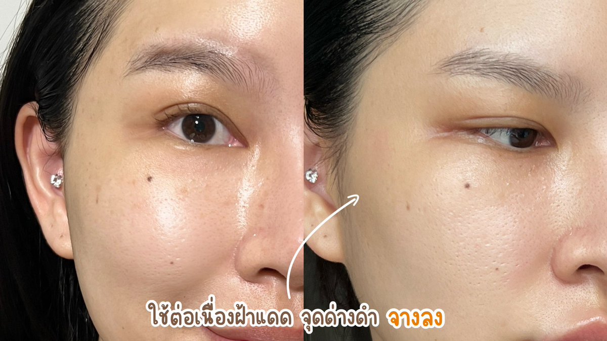 ยอมแล้วแดดเมืองไทยเดือดจริง ช่วงก่อนลุยแดดทากันแดดไม่ถึงด้วย ไหนจะความร้อน ความเหน่อะหน่ะ เลยทาน้อยลงไปอีก แล้วยิ่ง 30+ เสี่ยงฝ้า จุดด่างดำขึ้นมาก แล้วก็ฝ้าขึ้นจริง!! 🥹 จิตตกเลยจ้า กลับมาโบกกันแดดด่วน ยังดีที่กู้กลับมาได้

เพราะไปเจอมาว่ากันแดดที่ดี นอกจากปกป้องสูงแล้ว ยังต้องควรบำรุงผิว ดูแลผิวได้ด้วย เราขอยกความดีความชอบให้ Eucerin Sun Spotless Brightening ตัวนี้เลย เขากันแดดจบฝ้า ปกป้องสูงครบทุกรังสี UVA/UVB และแสงสีฟ้า ด้วย SPF50+ PA++++ ☀️🧡 ที่เขาเก่งกว่ากันแดดทั่วไปเพราะเขามี Thiamidol เป็นสารไบรท์เทนนิ่งที่ดีสุดจากยูเซอรินเลย ที่ทำให้ฝ้า รอยดำต่างๆจางลงดีสุดๆ

เห็นผลตั้งแต่ 2 อาทิตย์แรกที่ใช้เลย ส่วนตัวใช้แล้วผิวมันไบรท์ขึ้นมาก
แดดเมืองไทยจะแค่ไหนก็เอาอยู่ตอนนี้ไม่กลัวแดดแล้ว ใครที่หจะหากันแดดคุ้มๆ ตัวนี้ตอบโจทย์มากค่ะ เพราะถ้าจะเลือกกันแดดต้องเป้นกันแดดที่มากกว่าแค่การปกป้องนะคะ 😎

พิกัด : https://t.co/OohGEZxqrm

#กันแดดจบฝ้าปกป้องสูงครบทุกรังสีUV #EucerinThiland #กันแดดตัวจบ #ฝ้า #พิกัดสกินแคร์ #ป้ายยา #ใช้จริงรีวิวจริง