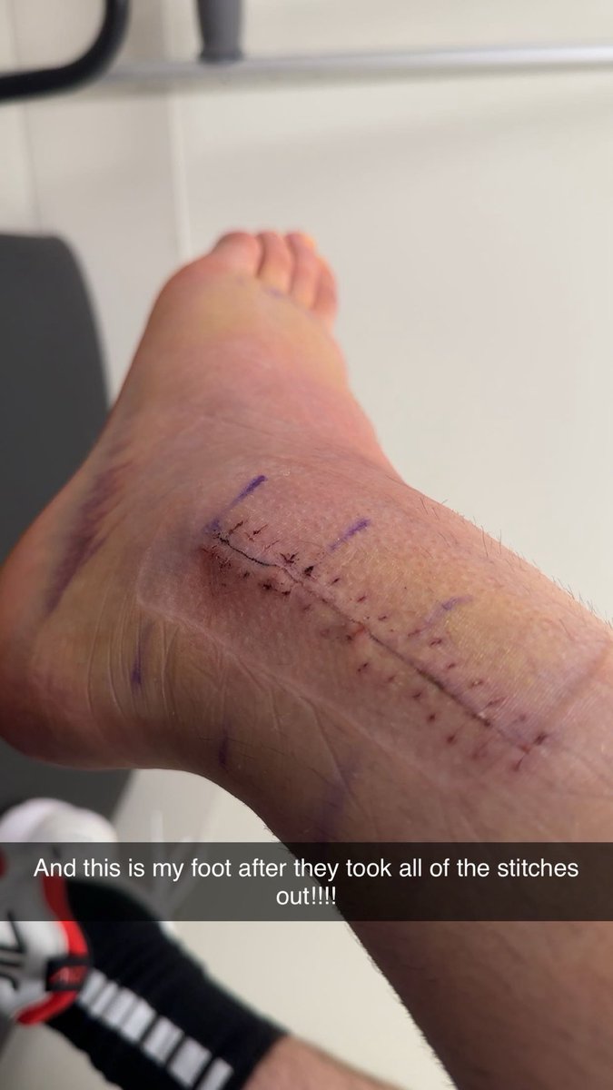 JordanJD23's tweet photo. Today was a day that I have been waiting for over 2 weeks to happen. I finally got my stitches removed from my foot after fracturing it and needing immediate surgery. https://t.co/5H3DwlCW3f