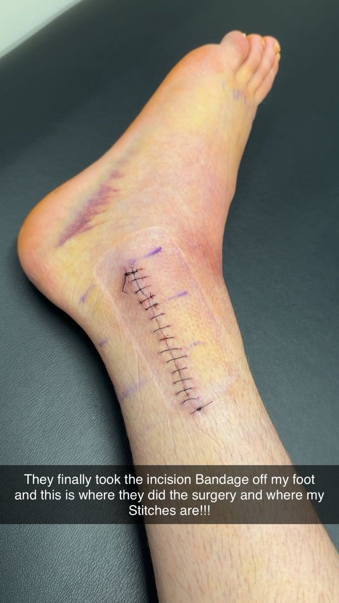 JordanJD23's tweet photo. Today was a day that I have been waiting for over 2 weeks to happen. I finally got my stitches removed from my foot after fracturing it and needing immediate surgery. https://t.co/5H3DwlCW3f