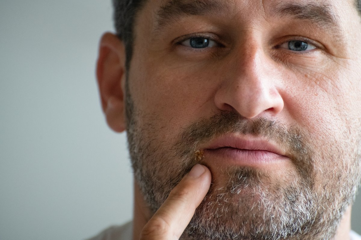 Might cold sores be implicated in a heightened risk of developing Alzheimer's disease? Read a large study in <a href="/BMJ_Open/">BMJ_Open</a> to find out. 
bit.ly/44LPMvb