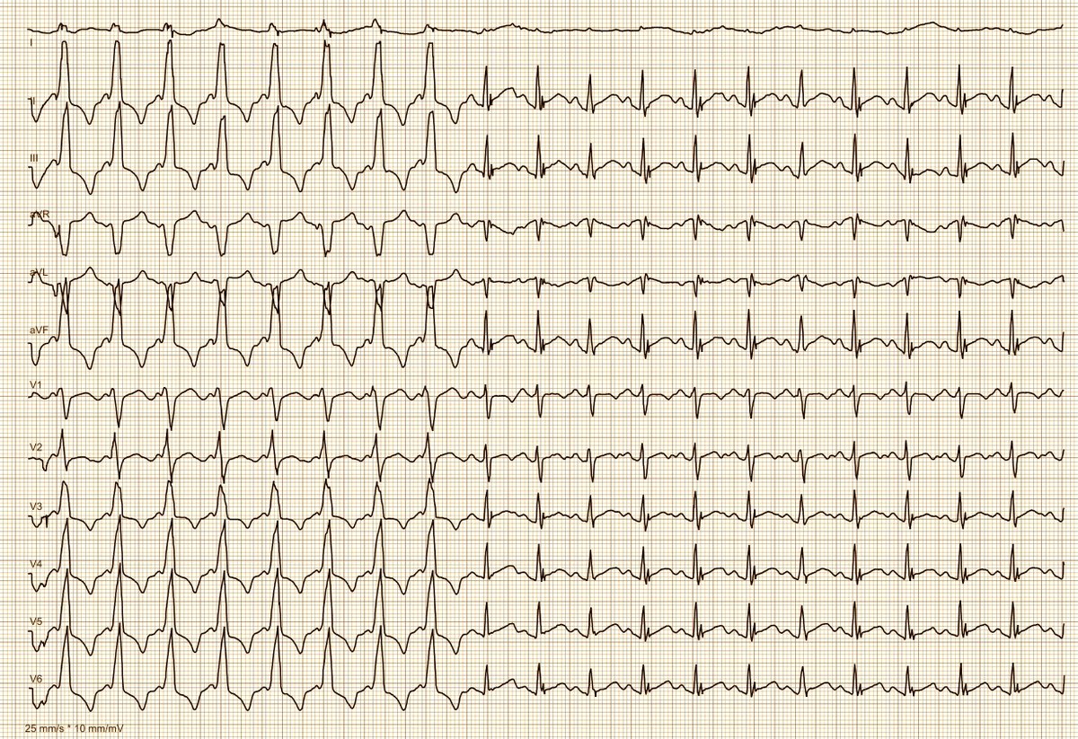 A 26 yo woman with intermittent palpitations, lasting up to 60 minutes. Can you explain this ECG?