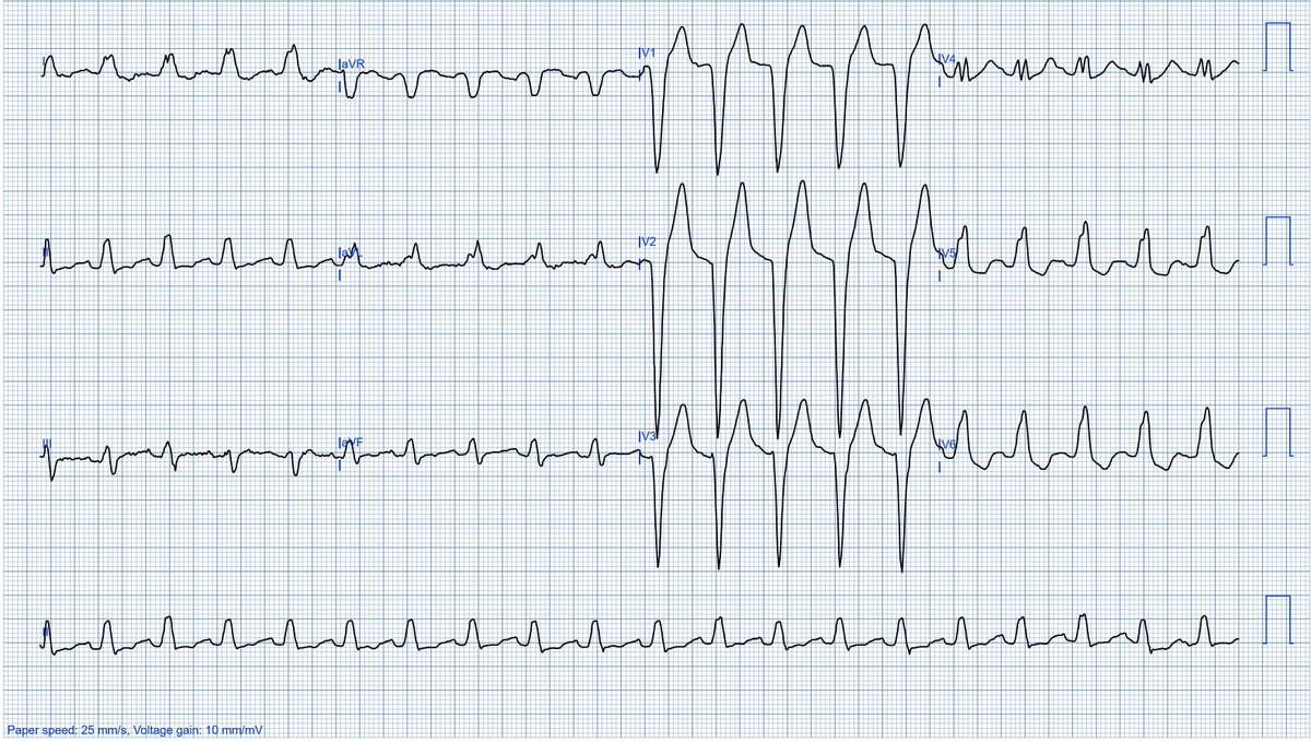 A 65-year-old man with mild, stabbing chest pain that has been coming and going for 3 days; are there any signs of acute ischemia (other than LBBB)?
ECG enhanced by PMcardio 😀