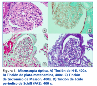 SENefrologia's tweet photo. 🔺CASO CLÍNICO CERRADO publicado en #NefroPlus
La importancia de la histopatología en el diagnóstico
de patología glomerular. Discordancia entre hallazgos serológicos e histológicos: https://t.co/Qp4c7803DX
Un caso de @HUCA_Asturias @astursalud https://t.co/tqGGJkpzxP