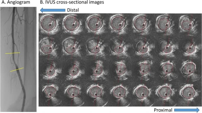 CIRSE European Trainee Forum (@etf_irtrainees) on Twitter photo Did you know? ๐ค
Diabetic patients face tougher #PADโlonger, more calcified lesions that are often underestimated. A new study in CVIR Endovascular explores using #IVUS-derived PFFR to better assess lesion severity without pressure wires.
๐ Read more: cvirendovasc.springeropen.com/articles/10.11โฆ Did you know? ๐ค
Diabetic patients face tougher #PADโlonger, more calcified lesions that are often underestimated. A new study in CVIR Endovascular explores using #IVUS-derived PFFR to better assess lesion severity without pressure wires.
๐ Read more: cvirendovasc.springeropen.com/articles/10.11โฆ