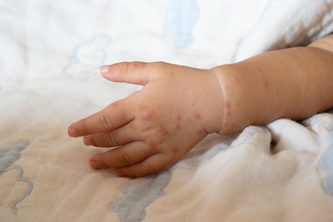 🟠 El #sarampión, una enfermedad que creíamos controlada, está resurgiendo en España. El repunte de casos ha encendido las alertas de Sanidad que hacen un llamamiento a la prevención.

👨‍⚕️💉 Lee la noticia completa y comparte: ihppediatria.com/repunte-saramp…