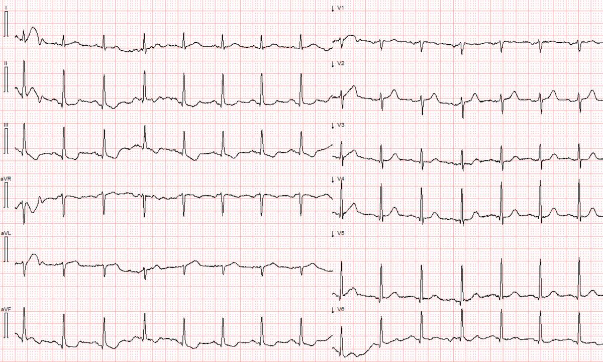 Stephen W. Smith (@smithecgblog) on Twitter photo The diagnosis is NSTEMI, a worthless diagnosis which harms patients.
hqmeded-ecg.blogspot.com/2025/05/the-di…
<a href="/MagnusNossen/">Magnus Nossen, MD</a> The diagnosis is NSTEMI, a worthless diagnosis which harms patients.
hqmeded-ecg.blogspot.com/2025/05/the-di…
<a href="/MagnusNossen/">Magnus Nossen, MD</a>