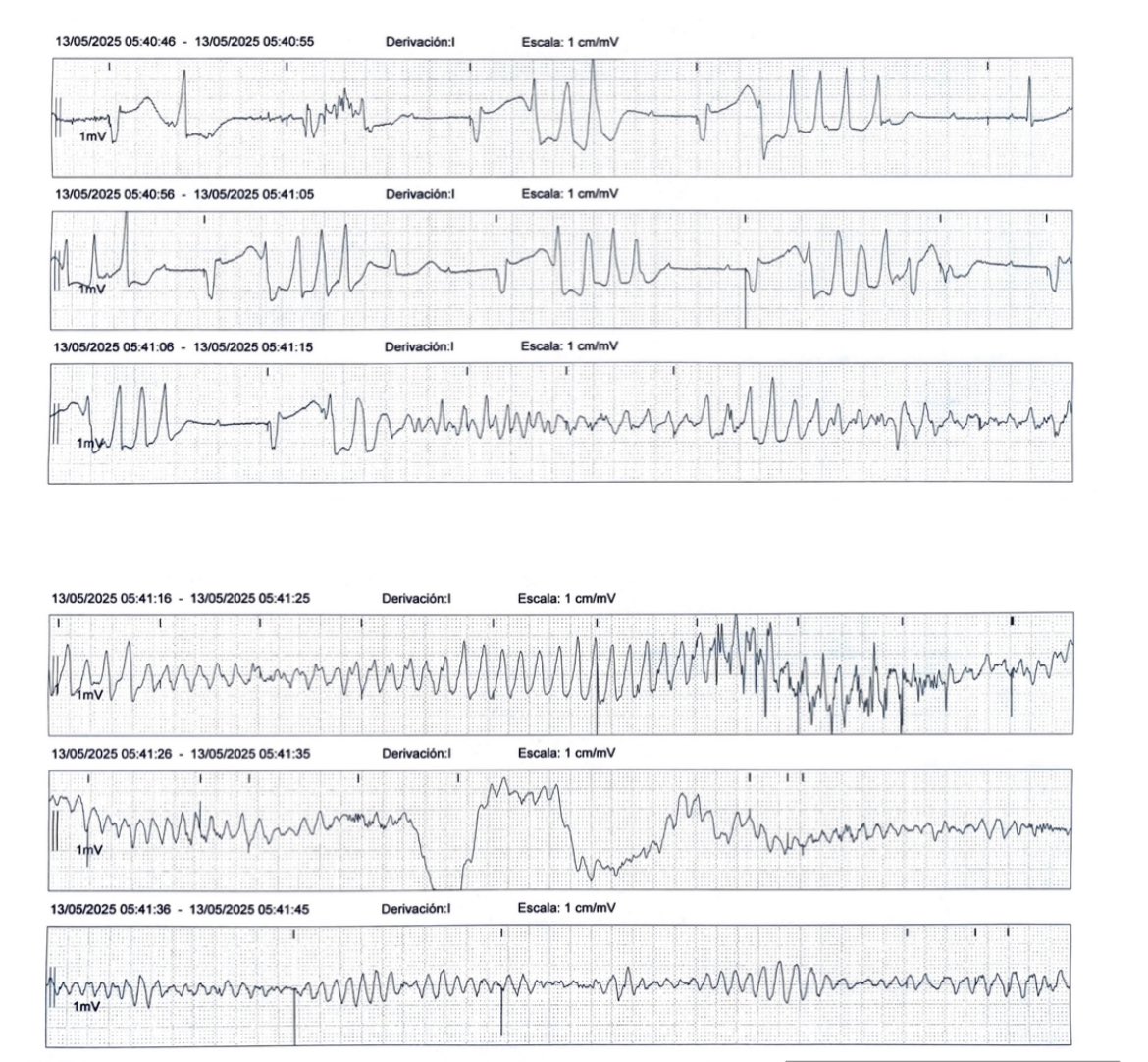 ALBERTO ALFIE (@alfieep1) on Twitter photo A temporary wire can save a life but also can kill a patient.
Be sure always to have a nice lead position and pacing threshold. This is the difference between life and death.
<a href="/EM_RESUS/">Sam Ghali, M.D.</a> A temporary wire can save a life but also can kill a patient.
Be sure always to have a nice lead position and pacing threshold. This is the difference between life and death.
<a href="/EM_RESUS/">Sam Ghali, M.D.</a>