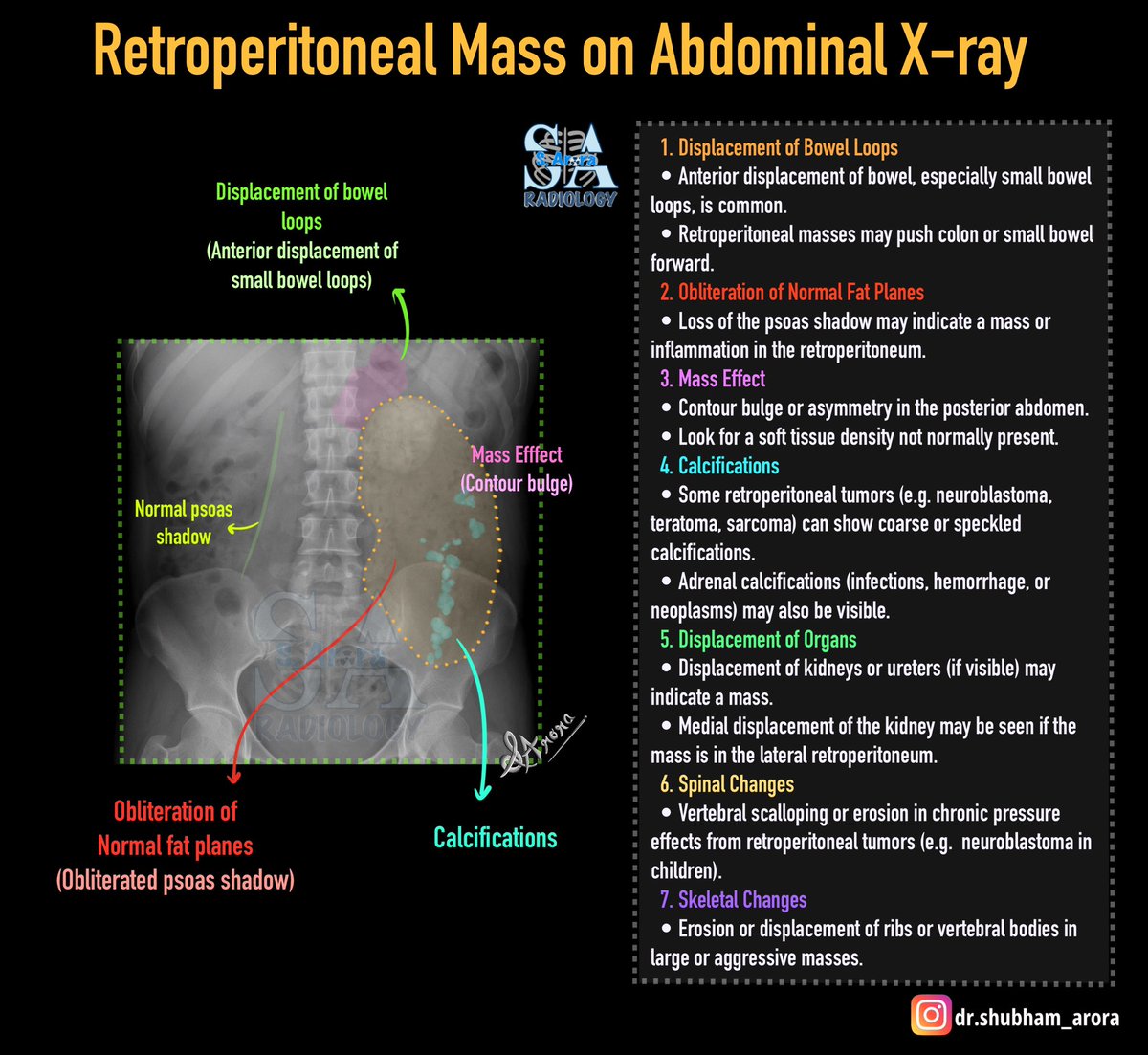 Dr_S_Arora's tweet image. Slide on retroperitoneal mass on abdominal xray.
#MedX #radiology