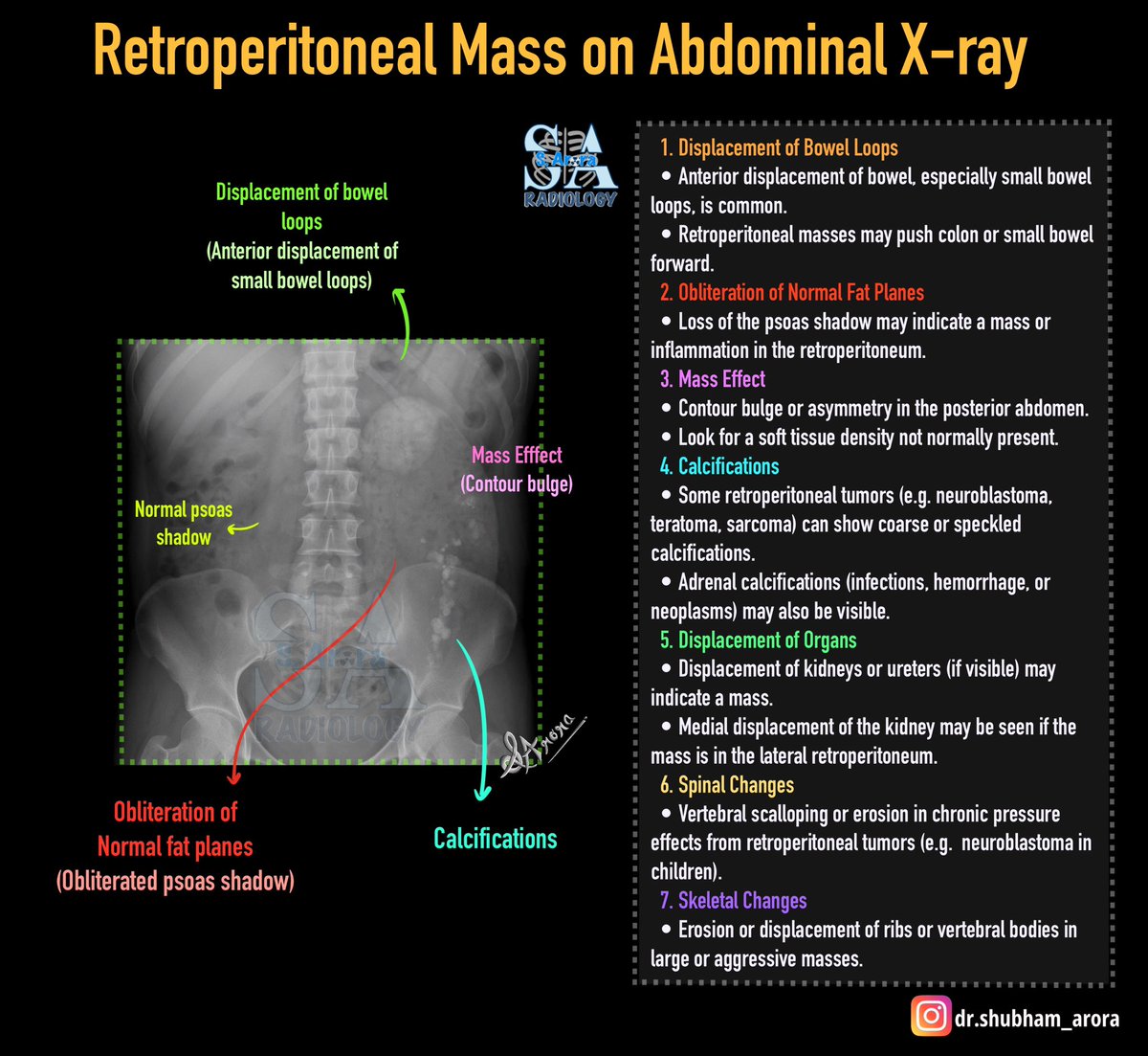 Dr_S_Arora's tweet image. Slide on retroperitoneal mass on abdominal xray.
#MedX #radiology