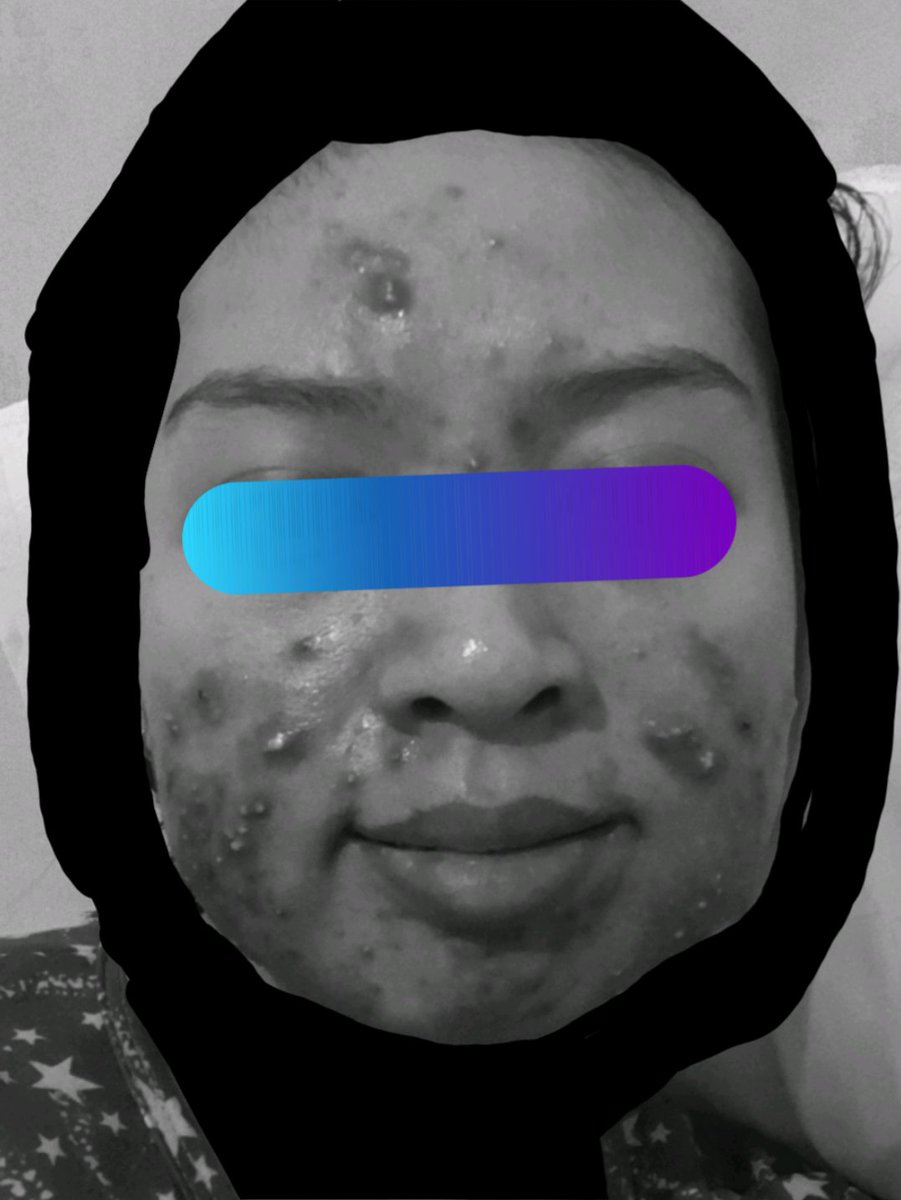 subdobby's tweet photo. TW/CW Acne.

Wta dong. Jerawat kalau udah separah ini mending ambil treatment apa ya?? Laser kah? IPL? peeling? Atau ya acne inject aja?Mungkin ada yg bisa sharing dampaknya juga.
Kemarin disaranin laser sih cuma karena downtimenya lama dan ada keperluan rl jadi blm treatment. https://t.co/dnYqWmwCAa