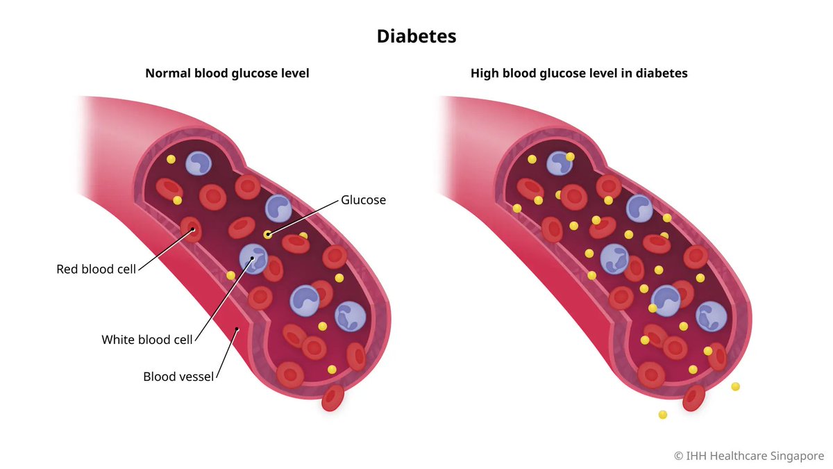DanielRaz_Fit's tweet image. Most doctors claim Type 2 diabetes is a progressive and lifelong sentence.

Yet Professor Roy Taylor&apos;s groundbreaking research proves it can be COMPLETELY REVERSED.

His 3 natural solutions that’s helped hundreds of patients: