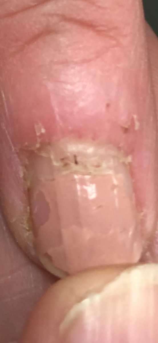 Janetbirdope's tweet photo. Does the pt have
👇
#primary #Raynaud’s #phenomenon
Or
#secondary #RP
Why? 🤷♀️
Hint
➡️Look at
#cuticle
#periungal area
#ClinicalPearl
#Diagnosis in 1 #picture
#MedEd #MedX #RheumEd #RheumX https://t.co/GiE6iYHyO2