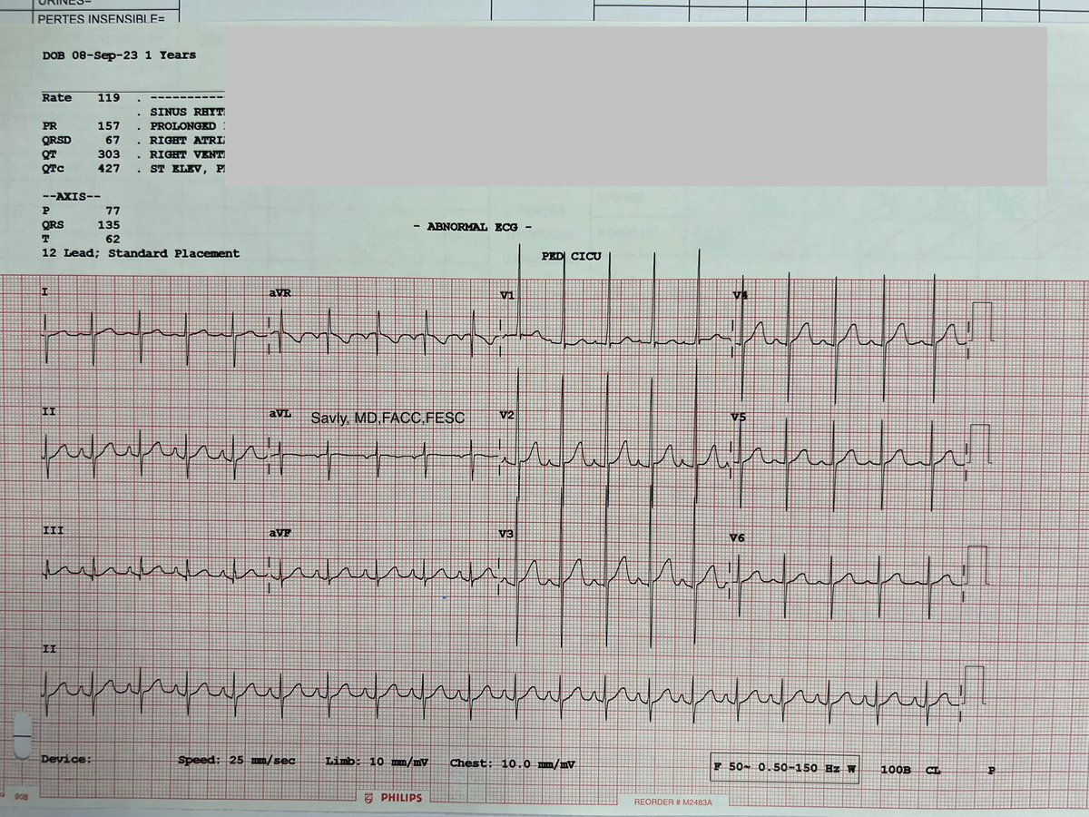 Oung Savly, MD,FACC,FASE,FESC,EACVI-CHD,FAPSC 🇰🇭 (@oungsavly) on Twitter photo 1-year-old, William syndrome
<a href="/jeffrey_vinocur/">Jeffrey M Vinocur</a> <a href="/RobertHPass/">Robert H. Pass</a> <a href="/iamritu/">Ritu Thamman MD</a> <a href="/KaraMotonaga/">Kara Motonaga</a> <a href="/loomba_rohit/">Rohit loomba</a> 1-year-old, William syndrome
<a href="/jeffrey_vinocur/">Jeffrey M Vinocur</a> <a href="/RobertHPass/">Robert H. Pass</a> <a href="/iamritu/">Ritu Thamman MD</a> <a href="/KaraMotonaga/">Kara Motonaga</a> <a href="/loomba_rohit/">Rohit loomba</a>