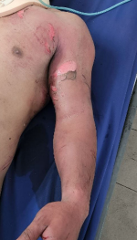 Trauma Surgery & Acute Care Open (TSACO) (@tsaco_aast) on Twitter photo Want to know how to build your own device to check for compartment syndrome entirely out of basic equipment available in any ED?
Asuncion et al describe the use of the Whitesides apparatus in the latest case report in <a href="/TSACO_AAST/">Trauma Surgery & Acute Care Open (TSACO)</a>:
➡️bit.ly/43bRsx2 Want to know how to build your own device to check for compartment syndrome entirely out of basic equipment available in any ED?
Asuncion et al describe the use of the Whitesides apparatus in the latest case report in <a href="/TSACO_AAST/">Trauma Surgery & Acute Care Open (TSACO)</a>:
➡️bit.ly/43bRsx2