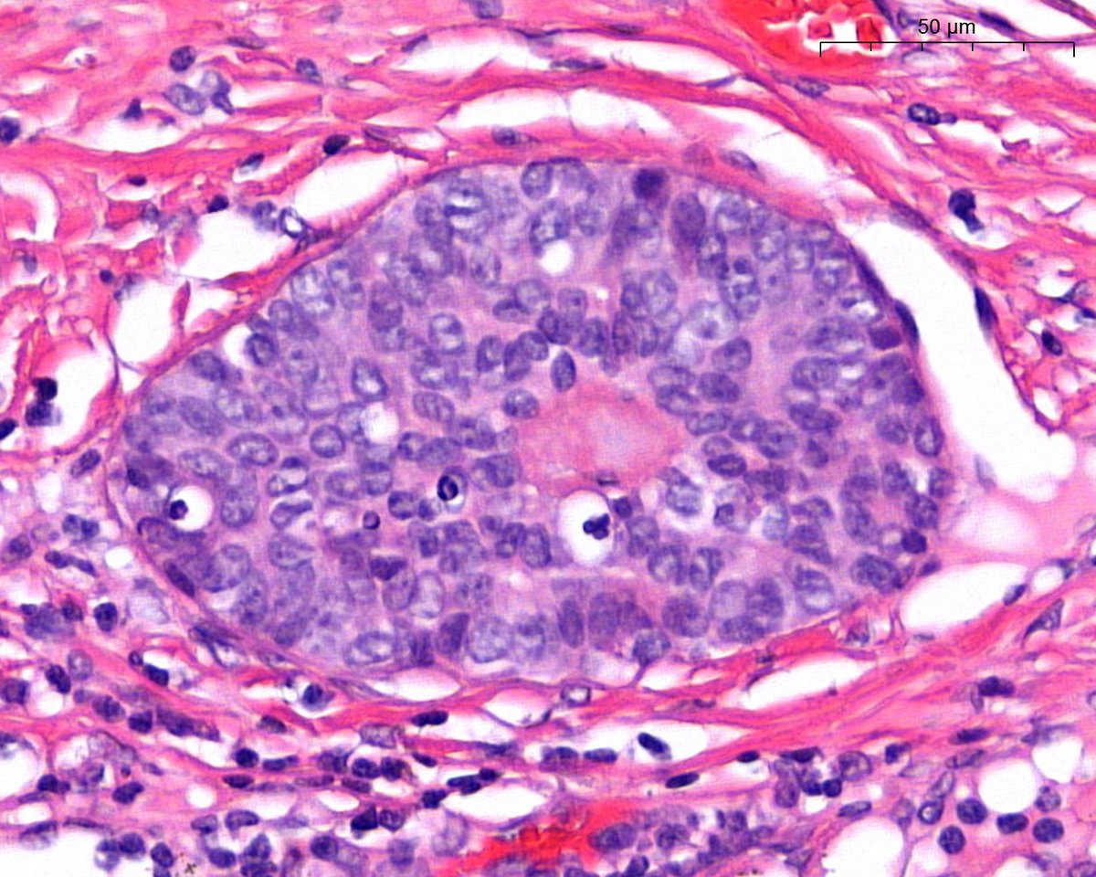 A. Polónia (@poloniaantonio) on Twitter photo Axillary lymph node 😃benign or malignant? <a href="/atman_ci/">Dr. Luca</a>
<a href="/DrGeeONE/">Olaleke Folaranmi</a> <a href="/fouad_boulos/">Fouad Boulos</a> <a href="/RazaHoda/">Raza Hoda MD</a> <a href="/ADamronMD/">Alexander Damron, MD</a> <a href="/Teclis82/">Brian McMillen MD</a> <a href="/LizaMQuintana/">Liza Quintana, MD</a> <a href="/tlabiano/">Tania Labiano</a> <a href="/A_Morini_MD/">Aurélien Morini, MD, MSc 🇫🇷🇪🇺💙💛</a> <a href="/ariella8/">Celina Stayerman MD</a> <a href="/surgpathlahore/">Nusrat Z. Bokhari</a> <a href="/amalasar86/">Amal Asar, FRCPath, MAcadMED</a> <a href="/TristanRutland7/">Tristan Rutland MBBS FRCPA IFCAP</a> <a href="/israhkhan/">Israh Akhtar Khan</a> <a href="/kis_lorand/">Lorand Kis</a> <a href="/padmapathology1/">Padma Priya J</a> <a href="/DrBMcGinn/">Barry McGinn</a> <a href="/Histopatolomon/">Pascual Meseguer</a> <a href="/Drmerm/">Med Amine, MD 🔬</a> Axillary lymph node 😃benign or malignant? <a href="/atman_ci/">Dr. Luca</a>
<a href="/DrGeeONE/">Olaleke Folaranmi</a> <a href="/fouad_boulos/">Fouad Boulos</a> <a href="/RazaHoda/">Raza Hoda MD</a> <a href="/ADamronMD/">Alexander Damron, MD</a> <a href="/Teclis82/">Brian McMillen MD</a> <a href="/LizaMQuintana/">Liza Quintana, MD</a> <a href="/tlabiano/">Tania Labiano</a> <a href="/A_Morini_MD/">Aurélien Morini, MD, MSc 🇫🇷🇪🇺💙💛</a> <a href="/ariella8/">Celina Stayerman MD</a> <a href="/surgpathlahore/">Nusrat Z. Bokhari</a> <a href="/amalasar86/">Amal Asar, FRCPath, MAcadMED</a> <a href="/TristanRutland7/">Tristan Rutland MBBS FRCPA IFCAP</a> <a href="/israhkhan/">Israh Akhtar Khan</a> <a href="/kis_lorand/">Lorand Kis</a> <a href="/padmapathology1/">Padma Priya J</a> <a href="/DrBMcGinn/">Barry McGinn</a> <a href="/Histopatolomon/">Pascual Meseguer</a> <a href="/Drmerm/">Med Amine, MD 🔬</a>