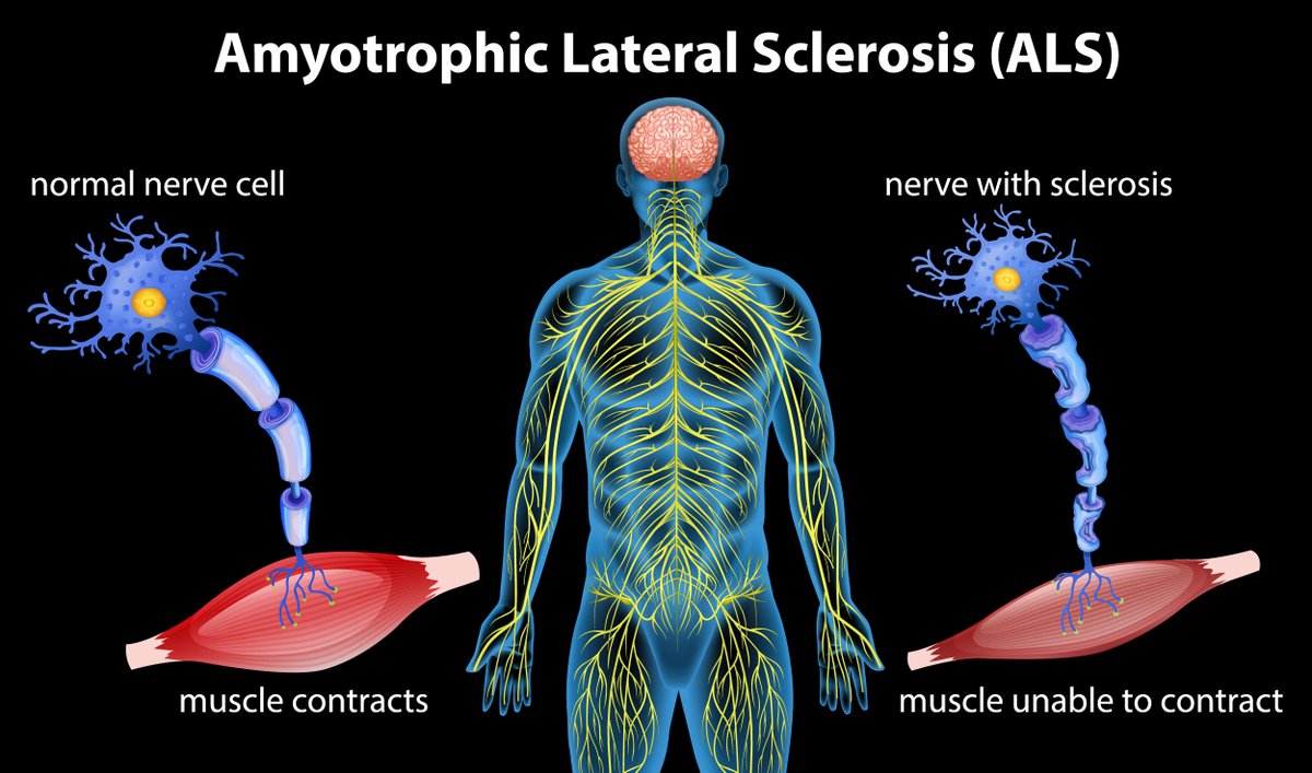 NCATS (@ncats_nih_gov) on Twitter photo A study supported by #NIH’s <a href="/rarediseasesnet/">Rare Diseases Clinical Research Network</a> used data from ~700 people with amyotrophic lateral sclerosis (#ALS) to study potential biomarkers — traits measured in blood or other bodily fluids & soft tissues — that could help researchers understand the disease’s progression & A study supported by #NIH’s <a href="/rarediseasesnet/">Rare Diseases Clinical Research Network</a> used data from ~700 people with amyotrophic lateral sclerosis (#ALS) to study potential biomarkers — traits measured in blood or other bodily fluids & soft tissues — that could help researchers understand the disease’s progression &