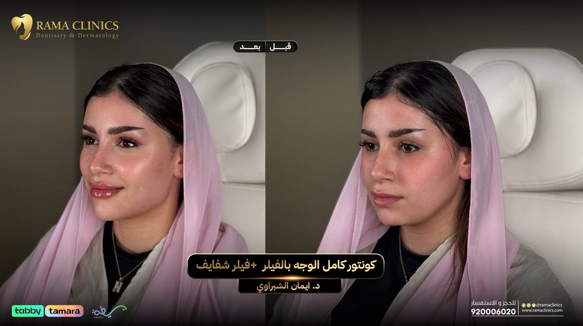 حاله كونتور كامل الوجه بالفيلر + فيلر شفايف مع د. إيمان الشبراوي 😍
<a href="/dr/">Dan Rowden</a>.eman.elshebrawy

الحين راح تستفيدي بكاش باك 20 % راجعين لك لما تشتري عروضنا من تطبيق راما أونلاين 🌸