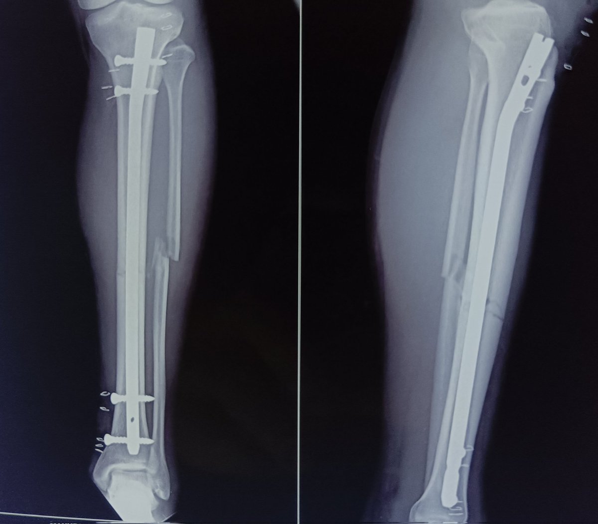 Just a routine tibia nailing! This surgery tests your physical strength throughout (gross motor)+ precision for distal interfrag insertion (fine motor)!

This surgery still makes me sweat as if I have done cardio in gym ! 

#medx #orthox #orthotwitter