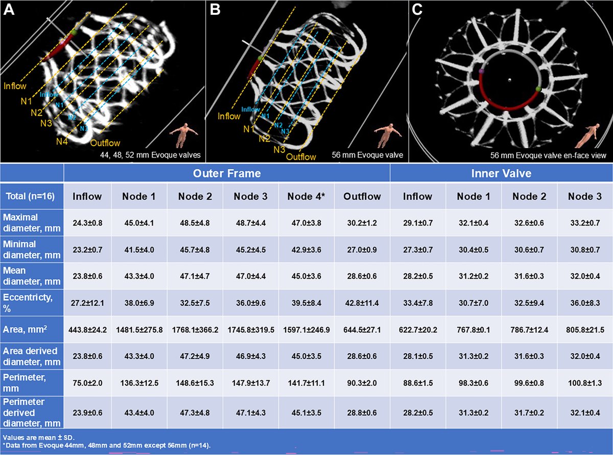 Dr. Gilbert Tang (@gilberttangmd) on Twitter photo JUST OUT <a href="/JACCJournals/">JACC Journals</a> #JACCINT our first-in-human #Evoque #TTVR CT analysis showing Evoque decoupling design of inner valve well expanded and outer frame conforming to native #tricuspid anatomy. Longer term follow-up will determine valve durability. <a href="/MountSinaiHeart/">Mount Sinai Fuster Heart Hospital</a> JUST OUT <a href="/JACCJournals/">JACC Journals</a> #JACCINT our first-in-human #Evoque #TTVR CT analysis showing Evoque decoupling design of inner valve well expanded and outer frame conforming to native #tricuspid anatomy. Longer term follow-up will determine valve durability. <a href="/MountSinaiHeart/">Mount Sinai Fuster Heart Hospital</a>