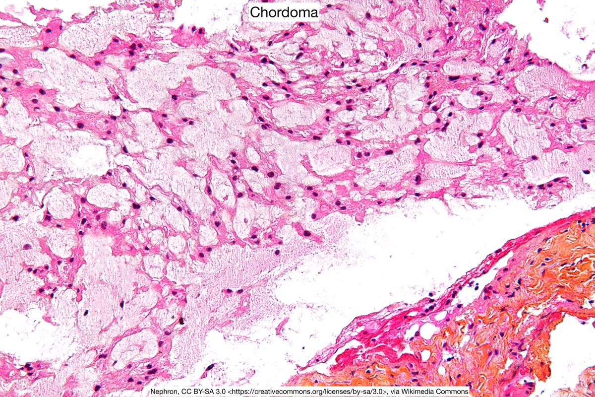 🧠 CHORDOID meningioma

🧠 It's WHO Grade 2 by definition.

🧠 It's called chordoid because it looks like a Chordoma

#pathx #neuropath #meningioma #neurology #neurosurgery #hemeonc #pathtwitter