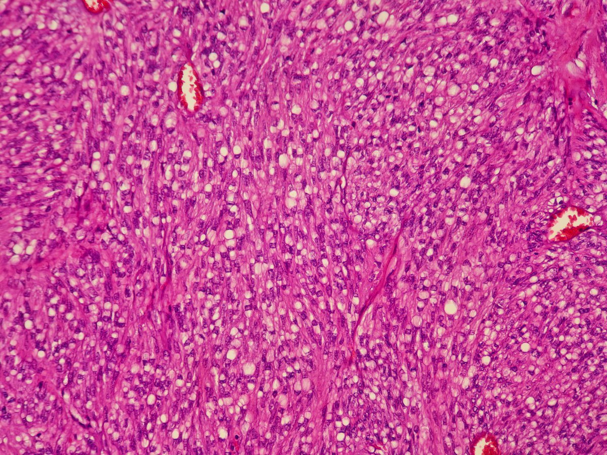 GIST imitating archipelago growth pattern of renal oncocytoma 🔬
Also 👀 beautiful paranuclear vacuoles characteristic of gastrointestinal stromal tumors.
The beauty of #pathology 

#GUPath + #BSTPath = ♥️
