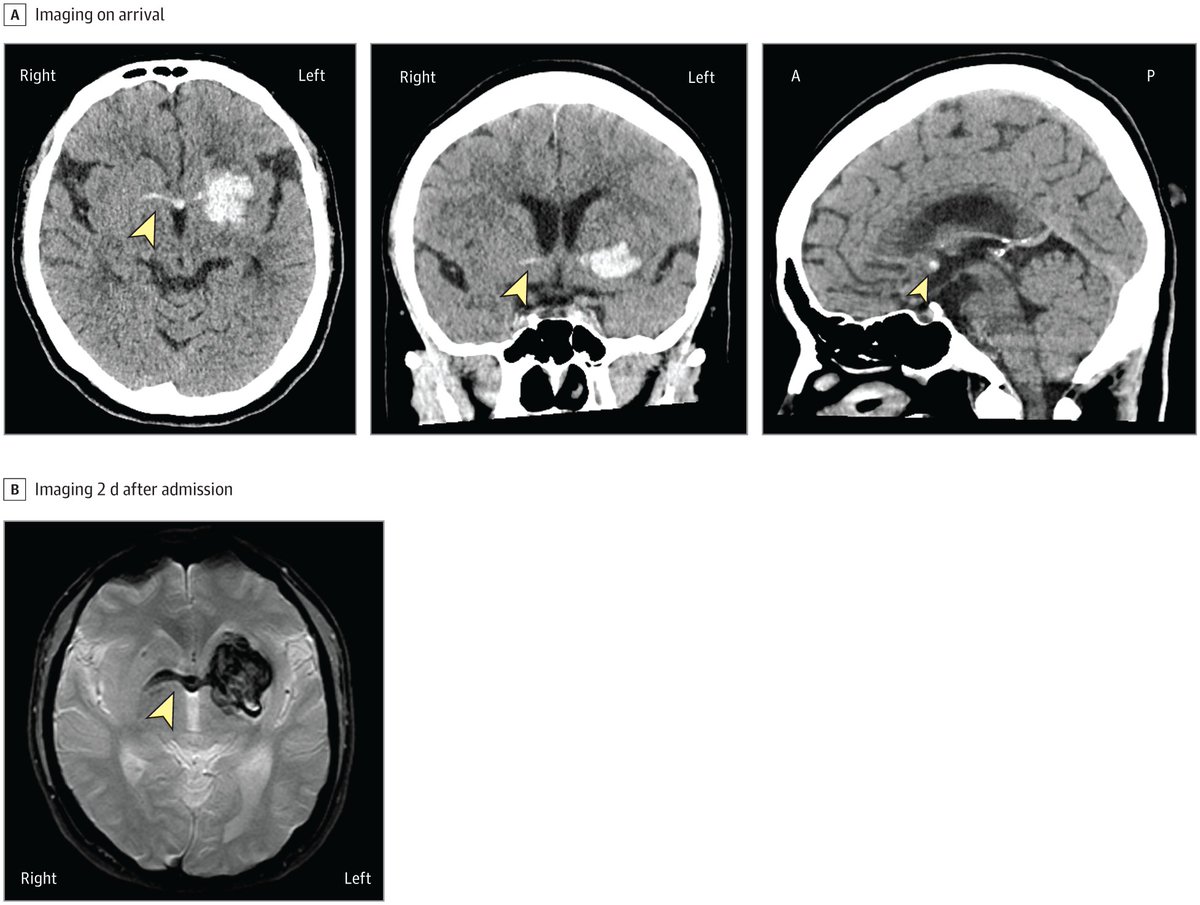 Images in Neurology: A 52-year-old woman suddenly collapsed in a public place and was brought to a hospital by ambulance, presenting with a decreased level of consciousness. 

ja.ma/3ZizxCv