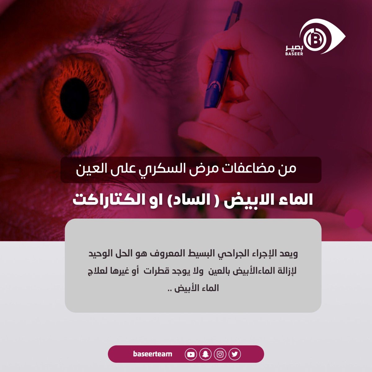 الماء الابيض "الساد" او الكتاراكت  من اكثر مضاعفات مرض #السكري على #العين شيوعا !!!