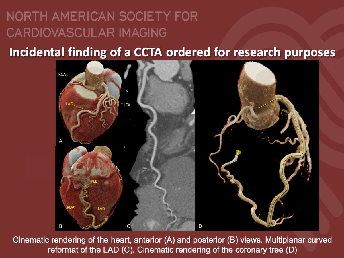 NASCI (@nascisociety) on Twitter photo #NASCI Case Series
Case 78
Courtesy of <a href="/DeCeccoCN/">Carlo N. De Cecco, MD, PhD</a> <a href="/CarlottaOnnis/">Carlotta Onnis</a> <a href="/marly_van_assen/">Marly van Assen</a> from <a href="/Heart_AI_Lab/">Emory Cardiothoracic Imaging & AI Lab</a> @EmoryRadiology
What is the right answer?
#whyCMR #YesCCT
<a href="/GregKicska/">Gregory Kicska</a> <a href="/JRevRad1/">Jonathan Revels DO, FSAR</a> <a href="/dianalitmano/">diana litmanovich</a> <a href="/DanielVargasMD/">Daniel Vargas, MD</a> <a href="/kirschj/">Jacobo Kirsch, MD, MBA, FACR</a> <a href="/prachipagarwal/">Prachi Agarwal</a> <a href="/AwsHamid5/">Aws Hamid, MD, MS</a> <a href="/EscrOffice/">ESCR Vienna</a> <a href="/DeCeccoCN/">Carlo N. De Cecco, MD, PhD</a> #NASCI Case Series
Case 78
Courtesy of <a href="/DeCeccoCN/">Carlo N. De Cecco, MD, PhD</a> <a href="/CarlottaOnnis/">Carlotta Onnis</a> <a href="/marly_van_assen/">Marly van Assen</a> from <a href="/Heart_AI_Lab/">Emory Cardiothoracic Imaging & AI Lab</a> @EmoryRadiology
What is the right answer?
#whyCMR #YesCCT
<a href="/GregKicska/">Gregory Kicska</a> <a href="/JRevRad1/">Jonathan Revels DO, FSAR</a> <a href="/dianalitmano/">diana litmanovich</a> <a href="/DanielVargasMD/">Daniel Vargas, MD</a> <a href="/kirschj/">Jacobo Kirsch, MD, MBA, FACR</a> <a href="/prachipagarwal/">Prachi Agarwal</a> <a href="/AwsHamid5/">Aws Hamid, MD, MS</a> <a href="/EscrOffice/">ESCR Vienna</a> <a href="/DeCeccoCN/">Carlo N. De Cecco, MD, PhD</a>