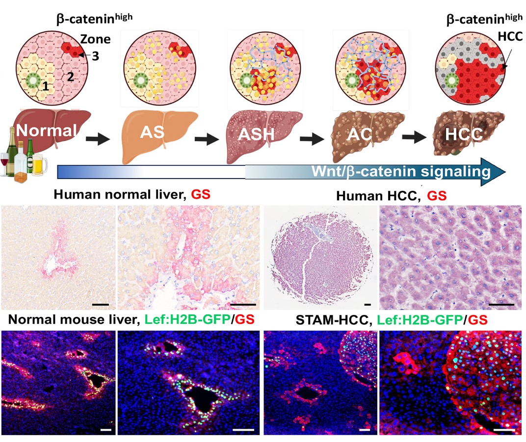 The American Journal of Pathology (@ajpathology) on Twitter photo #ArticleinPress: Alcohol‐Associated Hepatocarcinogenesis: Wnt/β-Catenin in Action. From <a href="/ASIPath/">American Society for Investigative Pathology</a> member author Dr. Liya Pi and colleagues from <a href="/Tulane/">Tulane University</a>.
#OpenAccess text: ajp.amjpathol.org/article/S0002-… #ArticleinPress: Alcohol‐Associated Hepatocarcinogenesis: Wnt/β-Catenin in Action. From <a href="/ASIPath/">American Society for Investigative Pathology</a> member author Dr. Liya Pi and colleagues from <a href="/Tulane/">Tulane University</a>.
#OpenAccess text: ajp.amjpathol.org/article/S0002-…