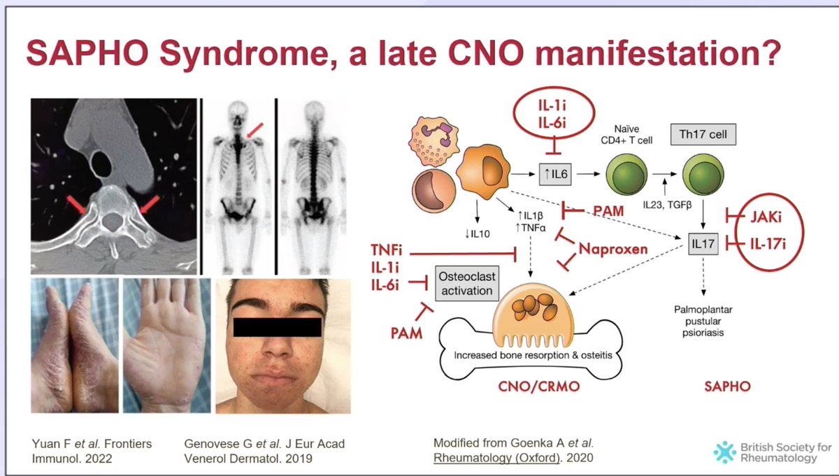 🚩Is SAPHO syndrome a late/delayed diagnosis of CNO? 
➡️Chronic activation of the innate response may via cytokines result in effector T-cell populations and later the onset of additional sx inc skin disease
✅Multiple targets IL17 and JAK (more effective in the skin) ❌ bone!