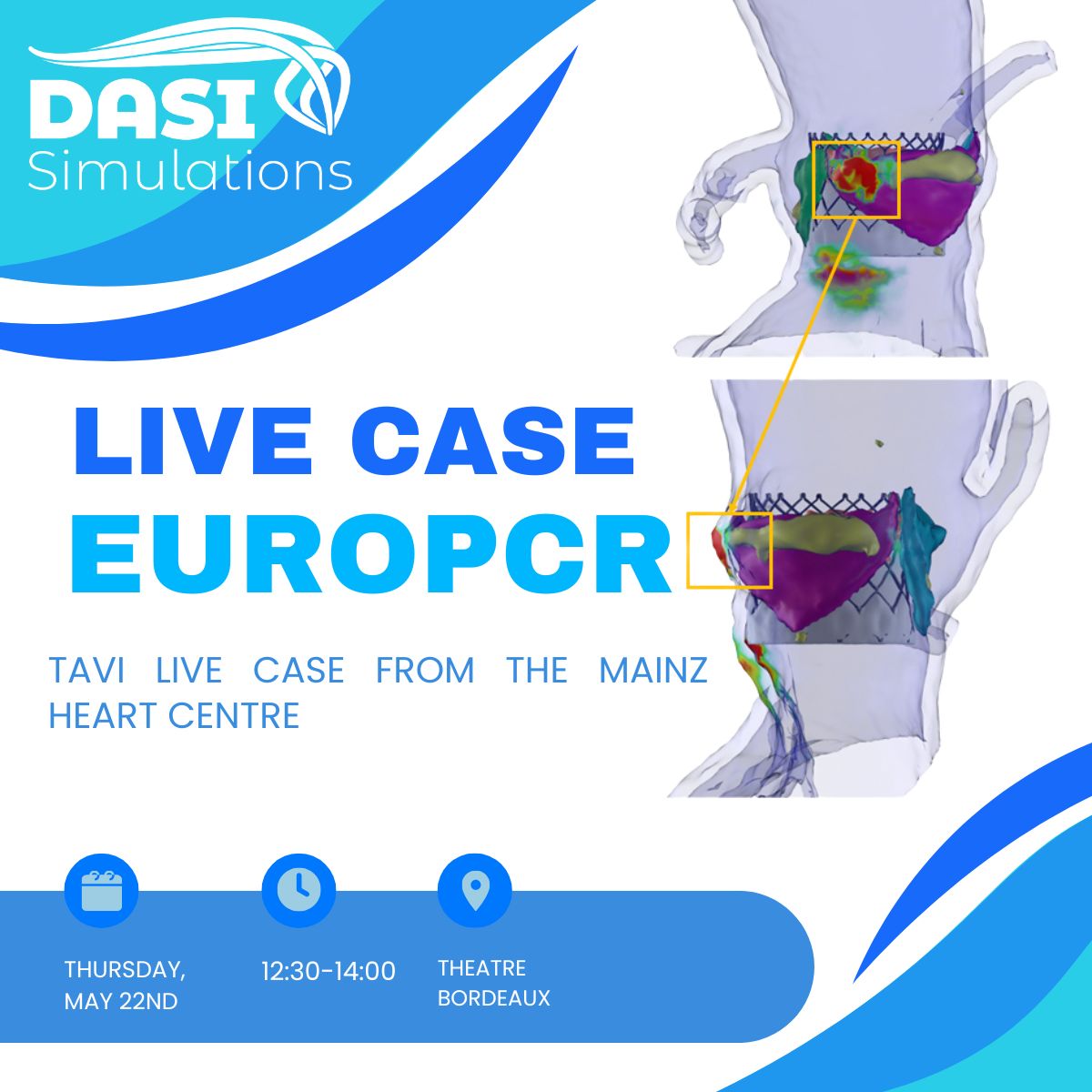 DASI Simulations LLC (@dasisimulations) on Twitter photo Join us tomorrow, Thursday, May 22nd at #EuroPCR for a live case from <a href="/UnimedizinMainz/">Universitätsmedizin Mainz</a>!
We’re excited to showcase our AI based predictive tools designed specifically for Lifetime Management — helping clinicians enhance precision and confidence in complex cases.
Case begins at Join us tomorrow, Thursday, May 22nd at #EuroPCR for a live case from <a href="/UnimedizinMainz/">Universitätsmedizin Mainz</a>!
We’re excited to showcase our AI based predictive tools designed specifically for Lifetime Management — helping clinicians enhance precision and confidence in complex cases.
Case begins at