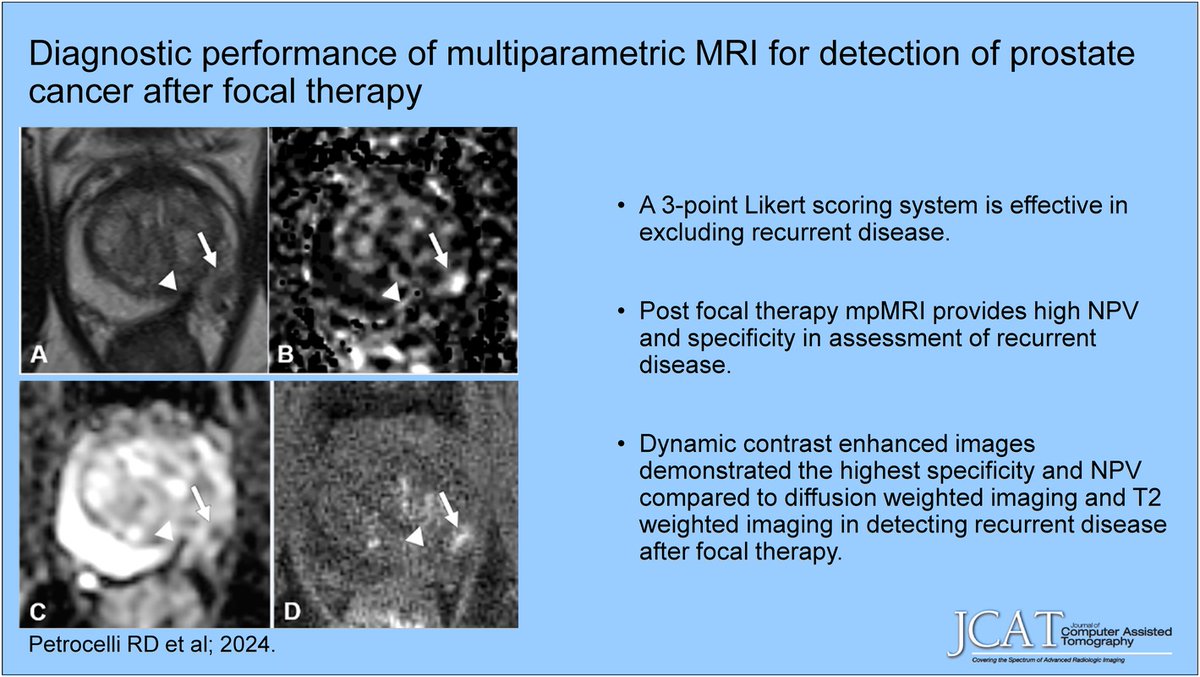 Eric Tamm, MD (@etammmd) on Twitter photo "New <a href="/JCATonline/">JCAT Online</a>
"New <a href="/JCATonline/">JCAT Online</a>
'Diagnostic Performance of Multiparametric MRI for Detection of Prostate Cancer After Focal Therapy'
May/Jun 25 dlvr.it/TKrDY3 Au: Robert Petrocelli et al. <a href="/NYUImaging/">NYU Langone Health Department of Radiology</a>,@atongMD
#MRI #prostatecancer "New <a href="/JCATonline/">JCAT Online</a>
"New <a href="/JCATonline/">JCAT Online</a>
'Diagnostic Performance of Multiparametric MRI for Detection of Prostate Cancer After Focal Therapy'
May/Jun 25 dlvr.it/TKrDY3 Au: Robert Petrocelli et al. <a href="/NYUImaging/">NYU Langone Health Department of Radiology</a>,@atongMD
#MRI #prostatecancer