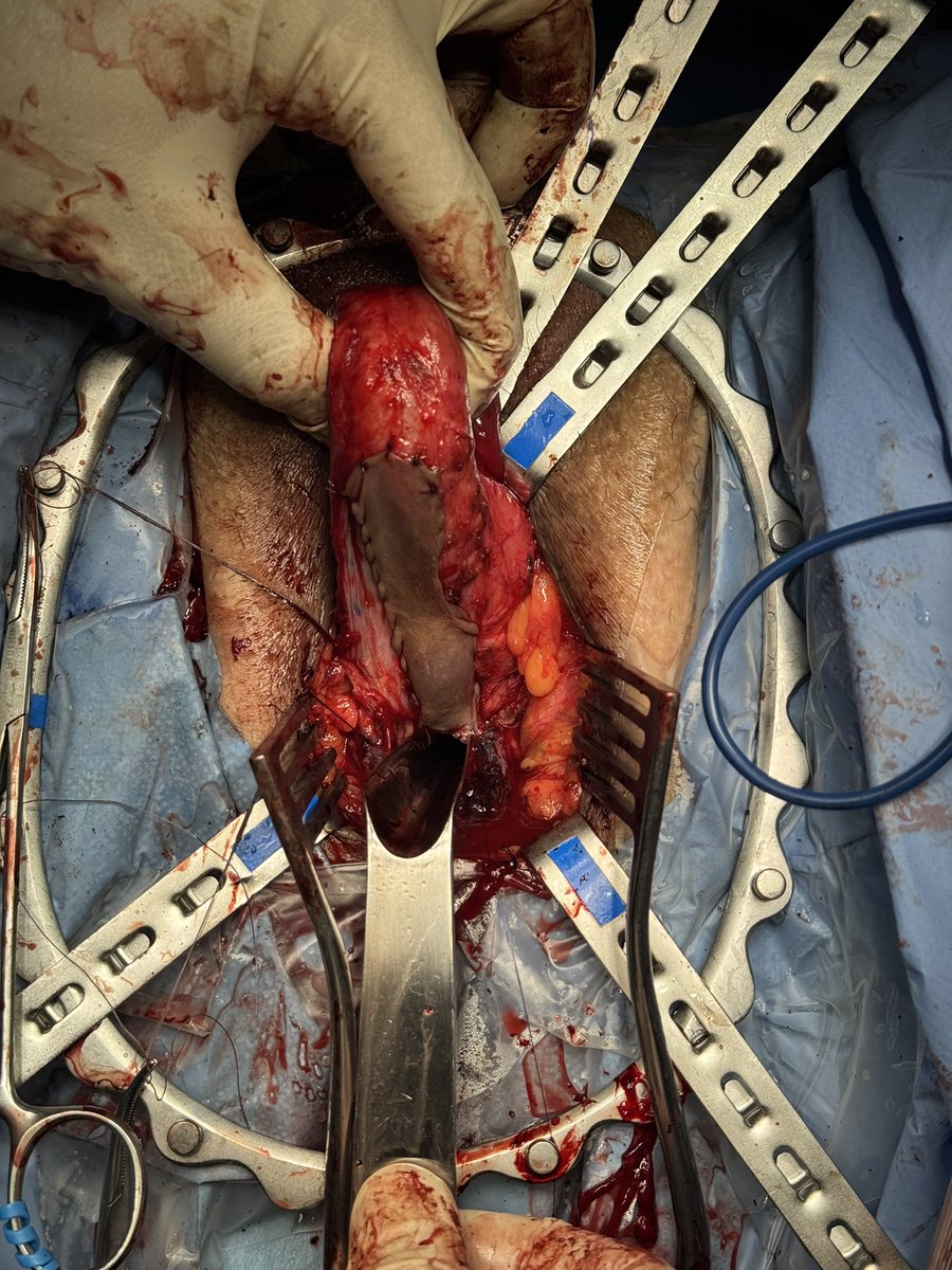 Roger Matheu (@roger_matheu) on Twitter photo Yesterday Preputial Spiral Graft Urethroplasty (Kulkarni technique)
An effective option for long penobulbar stenosis
✅ Single-stage reconstruction
✅ less oral morbidity
Thanks to <a href="/Andrewvicens/">Andrew Vicéns</a>, <a href="/sanjaybkulkarni/">Dr Sanjay Kulkarni</a>, <a href="/UroAlthaia/">Urologia Althaia</a>, <a href="/althaiamanresa/">Fundació Althaia</a>
#Urology #Urethroplasty Yesterday Preputial Spiral Graft Urethroplasty (Kulkarni technique)
An effective option for long penobulbar stenosis
✅ Single-stage reconstruction
✅ less oral morbidity
Thanks to <a href="/Andrewvicens/">Andrew Vicéns</a>, <a href="/sanjaybkulkarni/">Dr Sanjay Kulkarni</a>, <a href="/UroAlthaia/">Urologia Althaia</a>, <a href="/althaiamanresa/">Fundació Althaia</a>
#Urology #Urethroplasty
