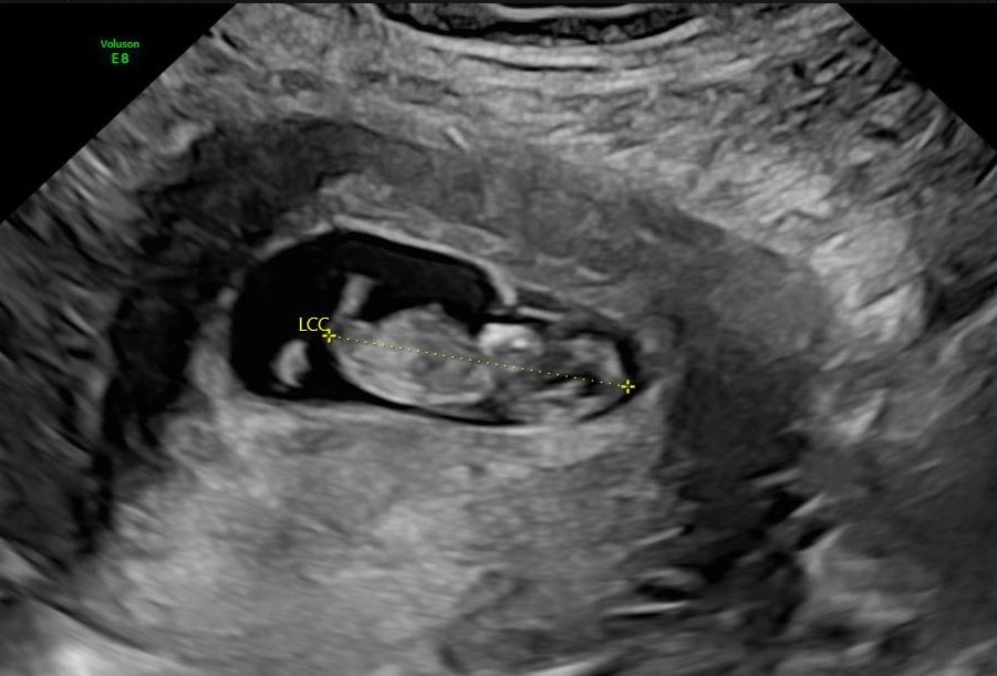 Du coup on a fait une pierre deux coups.. ❤️☀️🫂