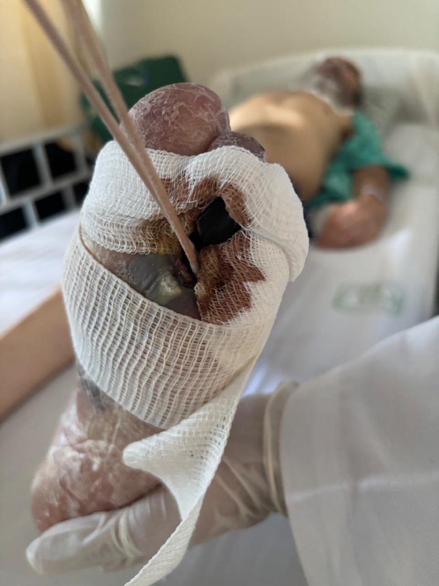 VERONICASORIA14's tweet photo. @Tu_IMSS Así ingresó con su dedo el 8 de marzo y por falta de atención y negligencia lleva este avance y el personal dice que así son los trámites administrativos, además dicen que van a tardar de 3 a 4 semanas en operarlo, mientras está ardiendo en temperatura todos los días y delirando. https://t.co/PFDxhpIx5E
